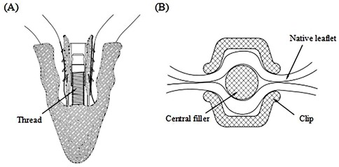 Illustration showing two diagrams labeled A and B. Diagram A displays a cross-sectional view of a threaded component within a surrounding structure. Diagram B presents a detailed view of a clip mechanism, with labels indicating the native leaflet, central filler, and clip. Both diagrams depict technical components and designs, presumably related to medical or engineering applications.