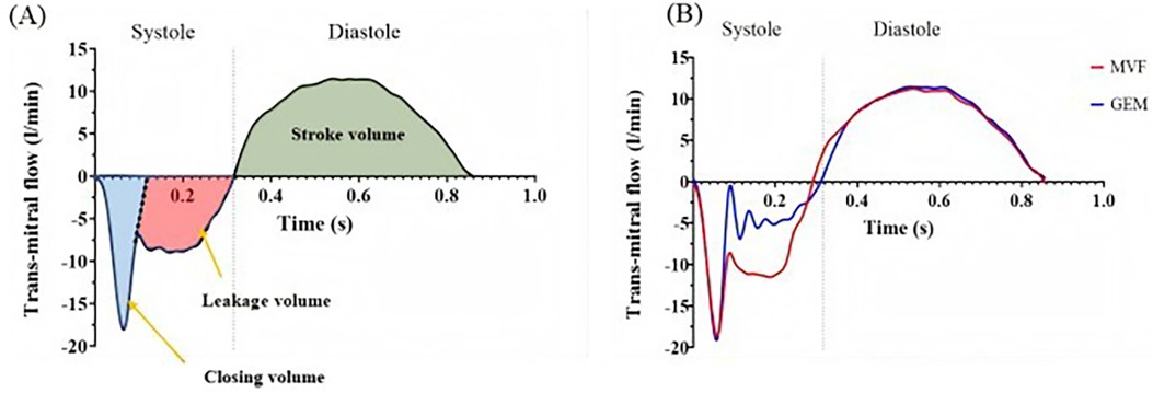 (A) Graph showing trans-mitral flow against time, with systole and diastole phases. Leakage volume is marked in red and closing volume in blue during systole; stroke volume is highlighted in green during diastole. (B) Graph comparing MVF and GEM trans-mitral flow, with two colored lines indicating their flow patterns over time.
