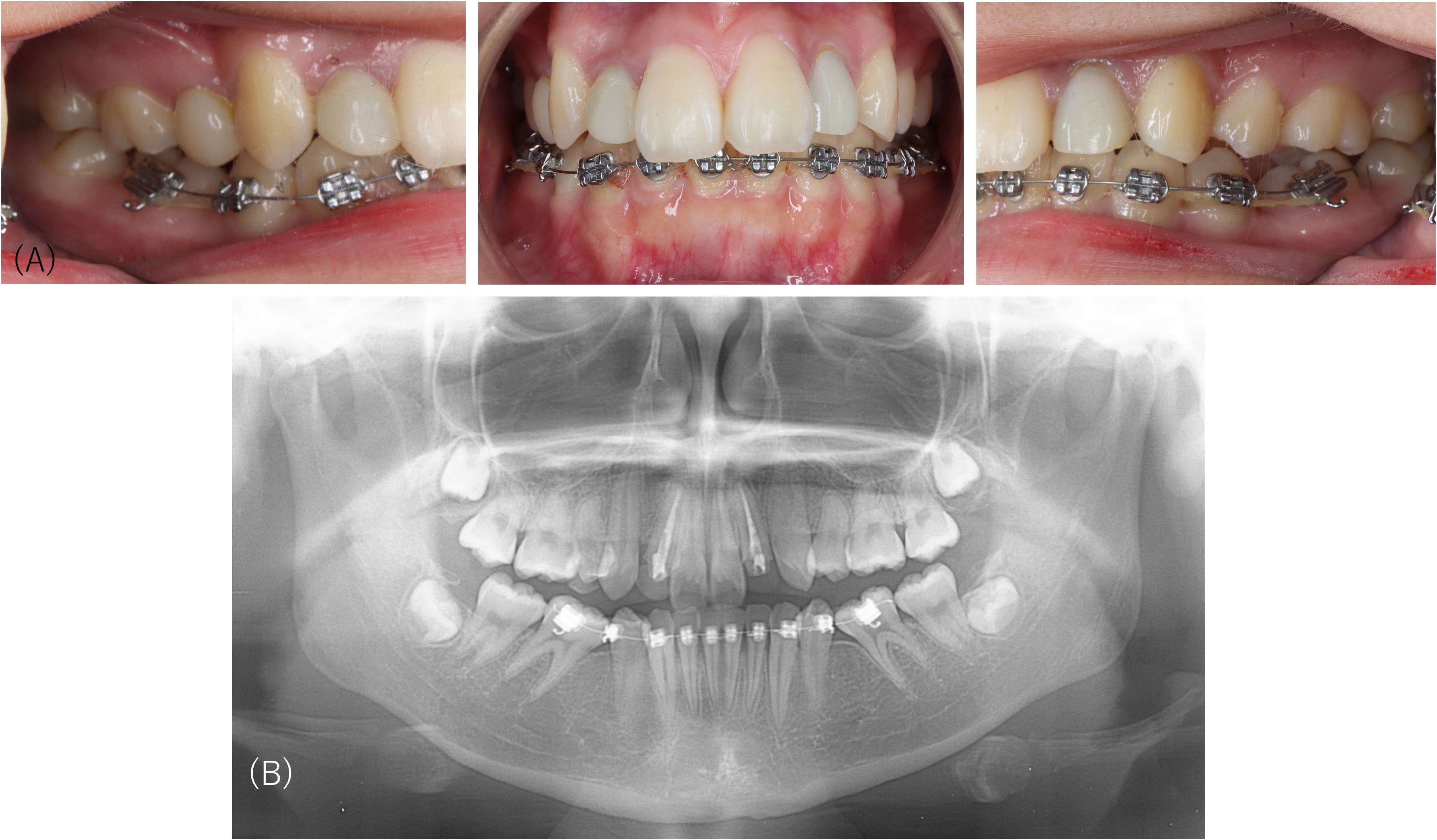 Three intraoral pictures wearing orthodontic devices and a panoramic radiograph. The top row includes two side views and a front view of teeth, showing alignment and occlusion. The bottom row displays a panoramic radiograph.