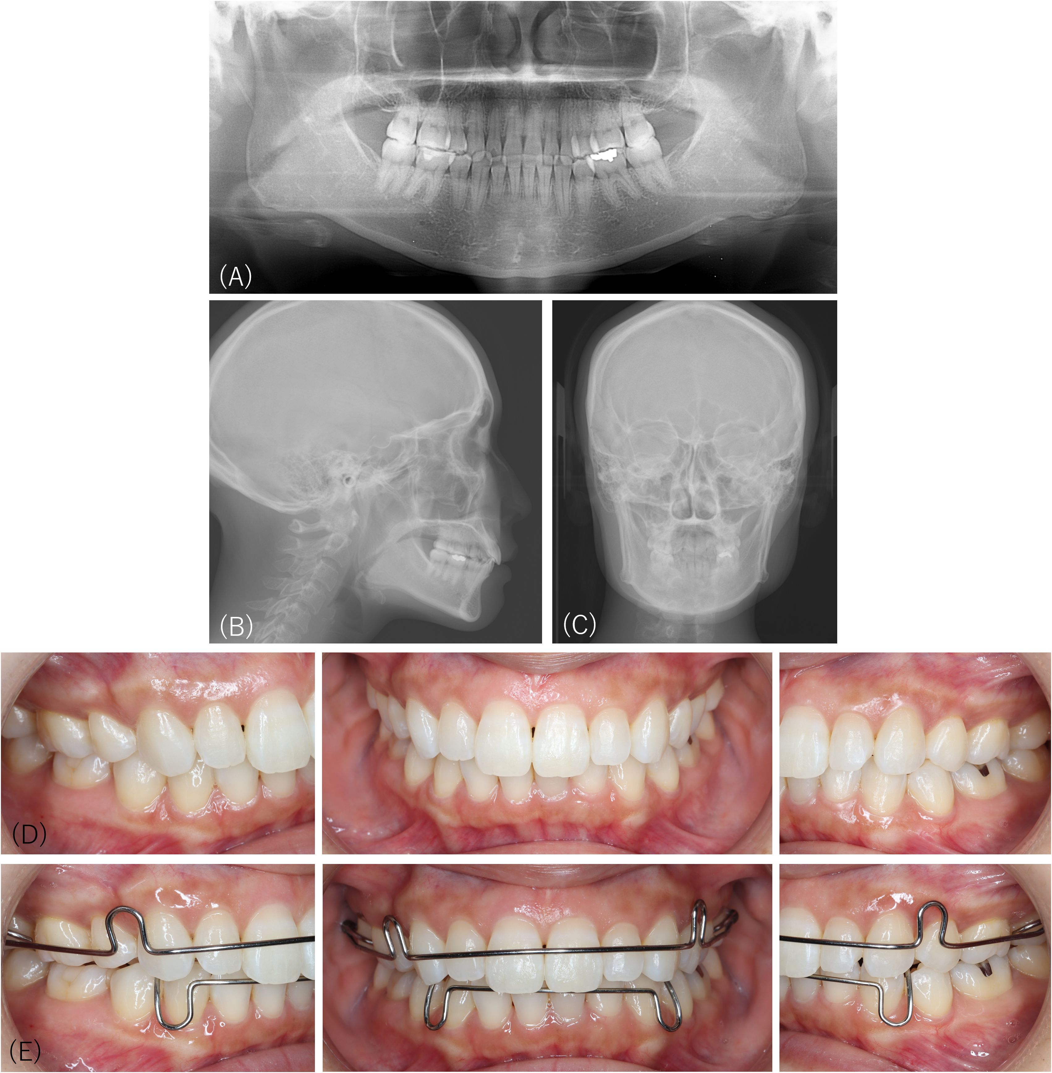 Radiographic images and intraoral photographs. Image (A) shows a panoramic view of the jaw with teeth alignment. Image (B) is a lateral view of the skull. Image (C) provides a frontal view. Images (D) and (E) display close-up views of teeth with and without the orthodontic retainer.