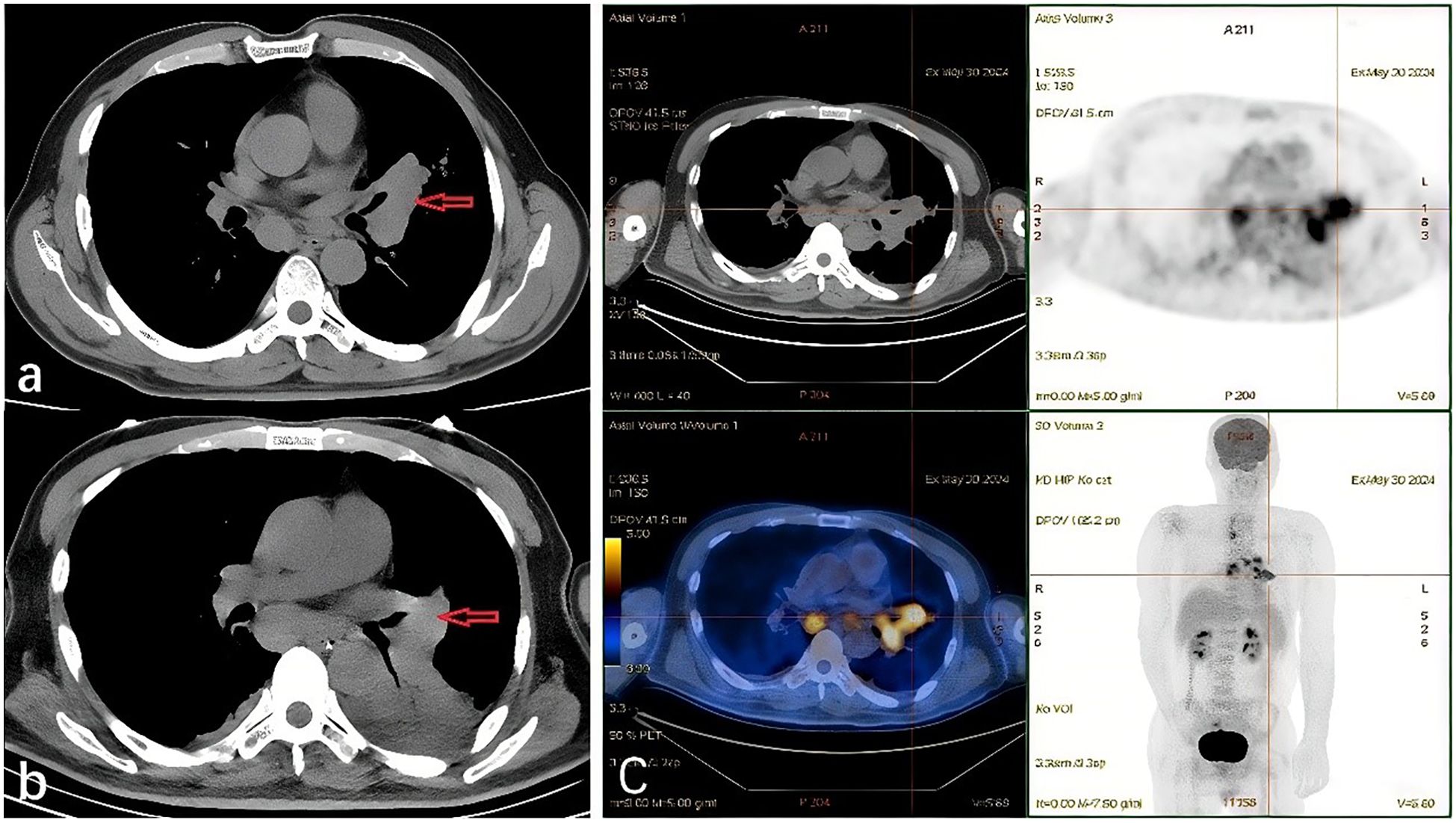 CT and PET scan images depict a cross-section of the chest and an overlay image of the body. In the left images labeled “a” and “b,” red arrows indicate areas of interest in the chest. On the right, PET scan results show metabolic activity, with noticeable dark regions. The full-body image highlights areas with higher uptake.