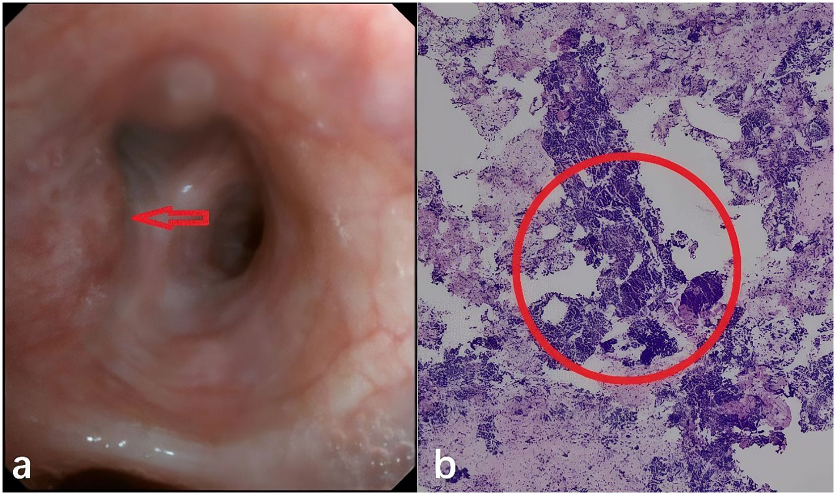 Panel (a) shows an endoscopic view of the esophagus with a red arrow pointing to a lesion or area of interest. Panel (b) displays a histological section with a red circle highlighting a specific region within the tissue.