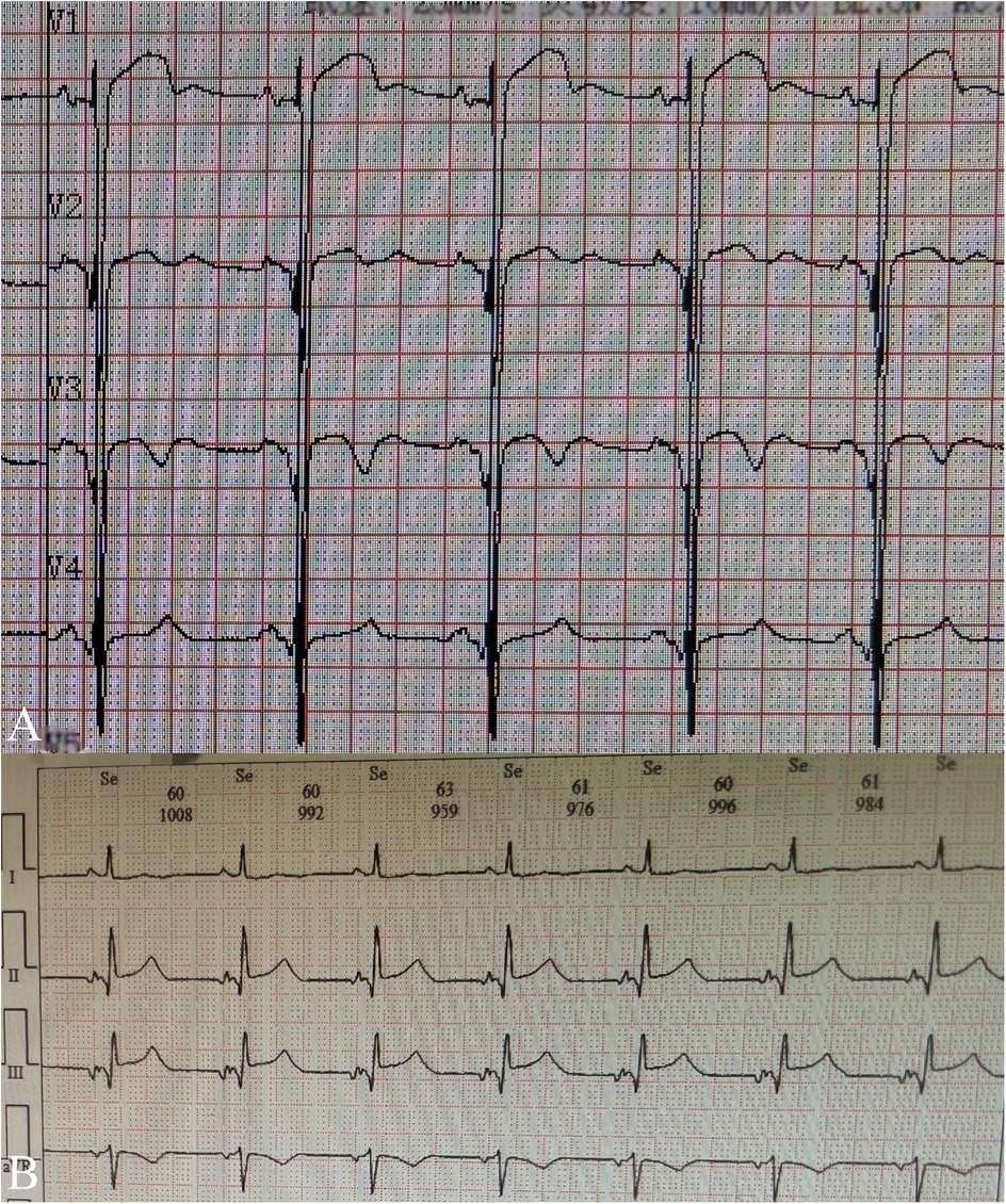 Two ECG tracings comparing heart rhythms. Image A shows leads V1 to V4, displaying irregular patterns. Image B shows leads I, II, and III with more regular, distinct waveform patterns.
