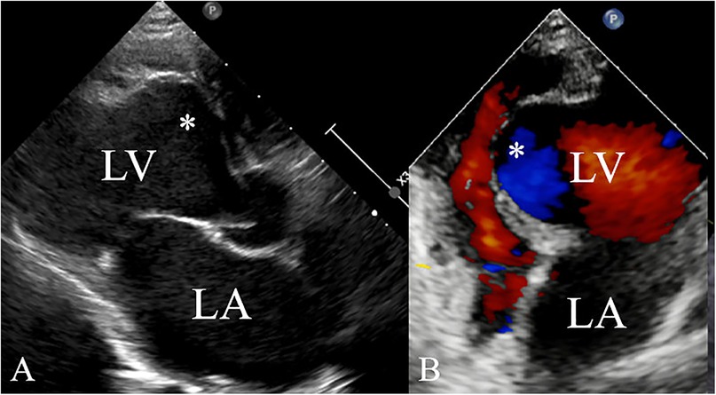 Echocardiogram images showing two panels: A) a grayscale view of the left ventricle (LV) and left atrium (LA) with an asterisk marking a specific area, and B) a color Doppler image showing blood flow in red and blue within the left ventricle and atrium, with the marked area highlighted.