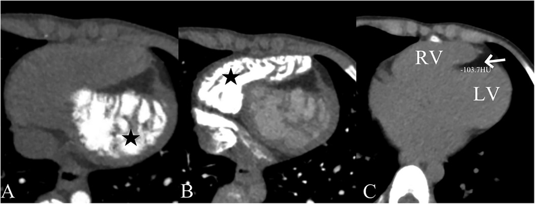 CT scan showing three panels. Panel A displays a marked area with a black star. Panel B shows a similar area with a star in the structure. Panel C identifies the right ventricle (RV), left ventricle (LV), and an arrow pointing to a region with a Hounsfield unit measurement of -103.7.