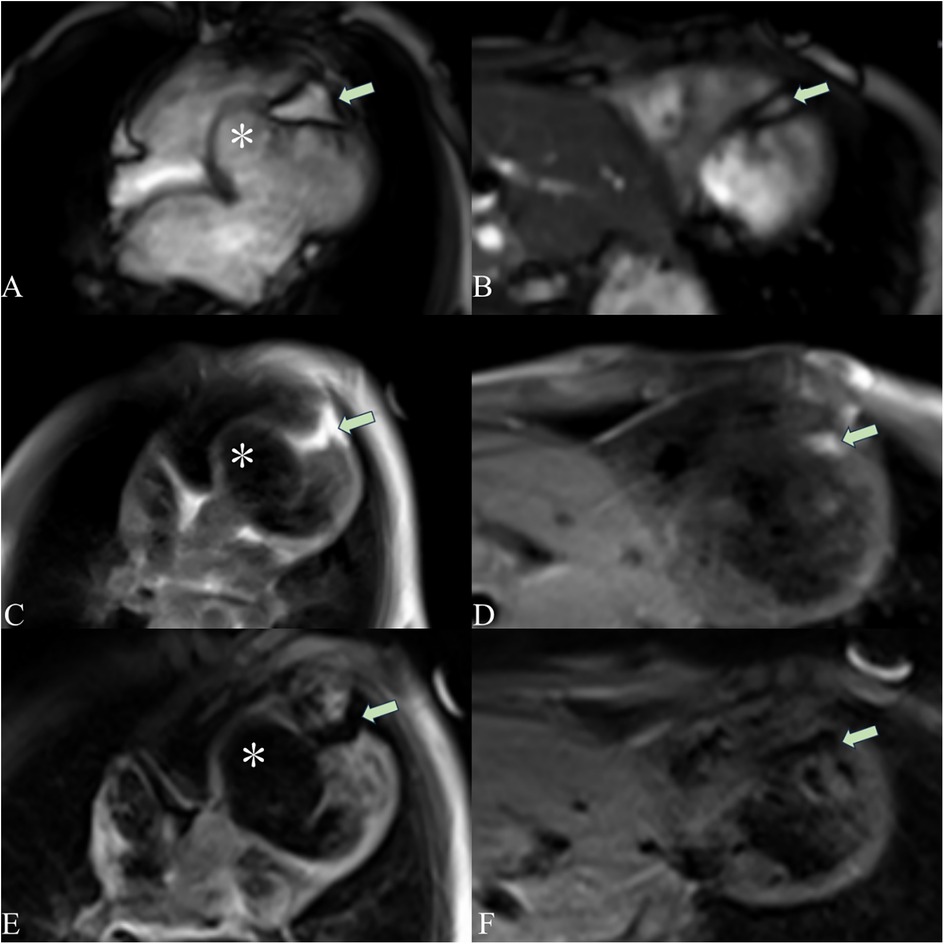 MRI scans in six panels labeled A to F. Panels A, C, and E show highlighted areas with an asterisk and arrow, pointing to distinct regions. Panels B, D, and F, also marked with arrows, display different anatomical views. Each image seems to focus on a specific area for medical analysis.