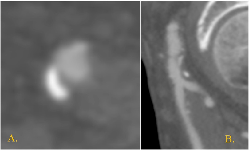 Medical images displaying two panels: Panel A shows a blurred, crescent-shaped object. Panel B exhibits a cross-sectional view of a tubular structure with a surrounding circular form, likely depicting anatomical or diagnostic imaging.