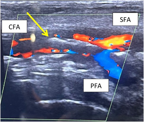 Ultrasound image showing color Doppler flow in a blood vessel. Labels indicate CFA, SFA, and PFA, with an arrow pointing at a specific area. Red and blue colors represent different flow directions.