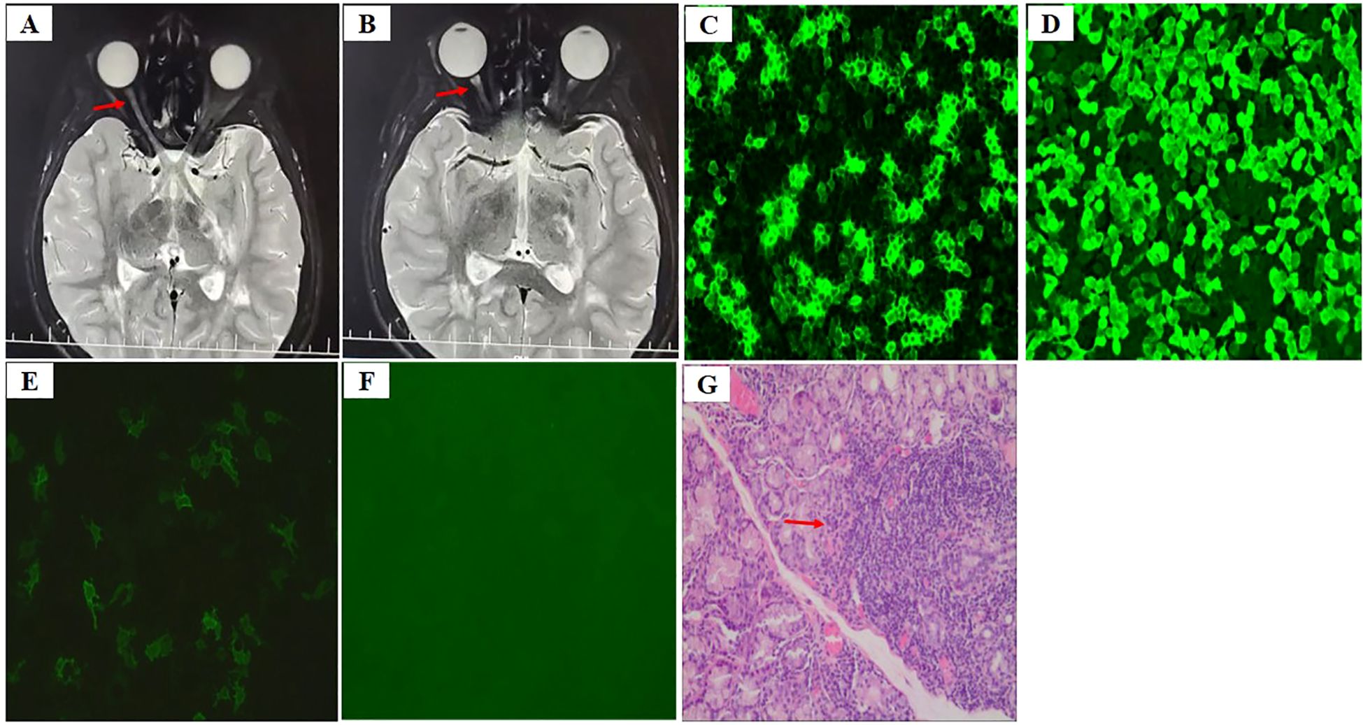 A series of medical images labeled A to G: A and B are brain MRI scans with red arrows indicating particular areas. C and D are microscopic images showing green-stained cells. E and F display darker microscopic fields with sparse green elements. G is a stained tissue section with a red arrow highlighting a specific feature.
