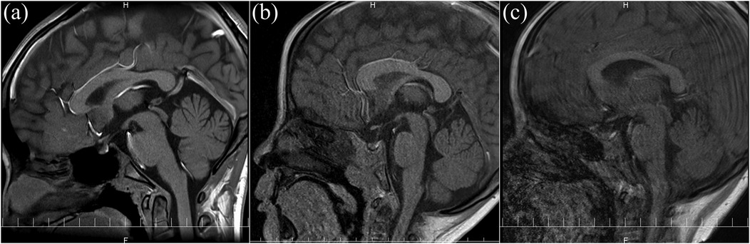 Three sagittal MRI images of the brain centered on the pituitary region are displayed side by side to illustrate varying levels of motion artifacts. Image (a) shows a high-quality scan without motion artifacts, with clear visualization of the pituitary stalk and surrounding midline structures. Image (b) demonstrates mild motion artifacts that slightly blur the image, but the pituitary region remains interpretable. Image (c) exhibits severe motion artifacts, resulting in significant blurring and reduced diagnostic value, rendering the pituitary anatomy difficult to evaluate. These images represent the spectrum of image quality outcomes in non-sedated pediatric MRI.