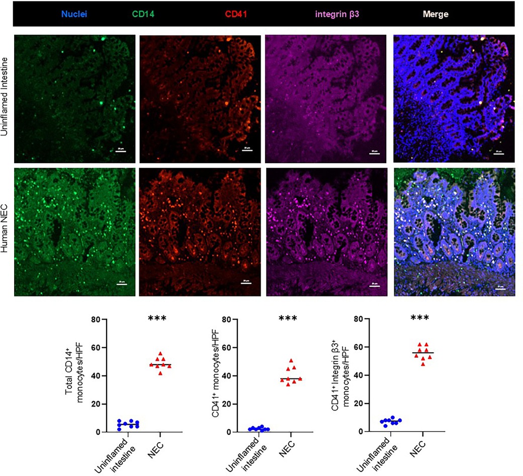 Fluorescent microscopy images and graphs comparing uninflamed intestine and human NEC tissues. Images show staining for nuclei (blue), CD14 (green), CD41 (red), and integrin β3 (purple), with a merged view. Below, three bar charts display measurements of CD14⁺ monocytes, CD41⁺ monocytes, and CD41⁺ integrin β3⁺ monocytes per high-power field (HPF), indicating higher levels in NEC tissues with statistical significance (represented by asterisks).