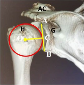 Annotated medical image of a shoulder joint, highlighting anatomical features. The humerus (H) is encircled in red with a marked center (O). The acromion (AC), glenoid (G), and a vertical line (A to B) are labeled, alongside a horizontal measurement (C).