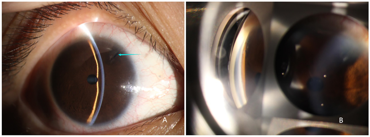Close-up images of an eye. Panel A shows a detailed view of the eye with a visible blue arrow pointing to a specific area on the sclera. Panel B displays a magnified, reflective view, likely using medical equipment, focusing on the eye's internal structures.