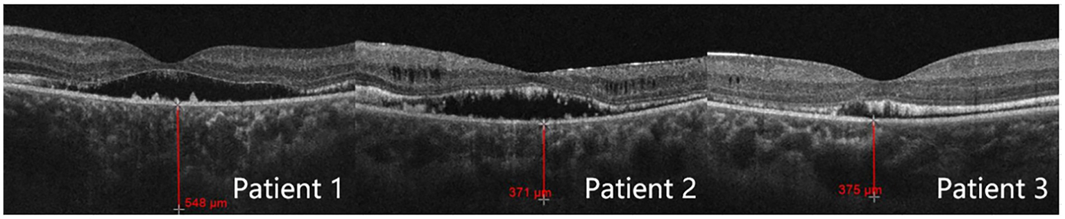 Optical coherence tomography images for three patients showing cross-sectional views of retinal layers. Measurements are highlighted: Patient 1 has 548 micrometers, Patient 2 has 371 micrometers, and Patient 3 has 375 micrometers.