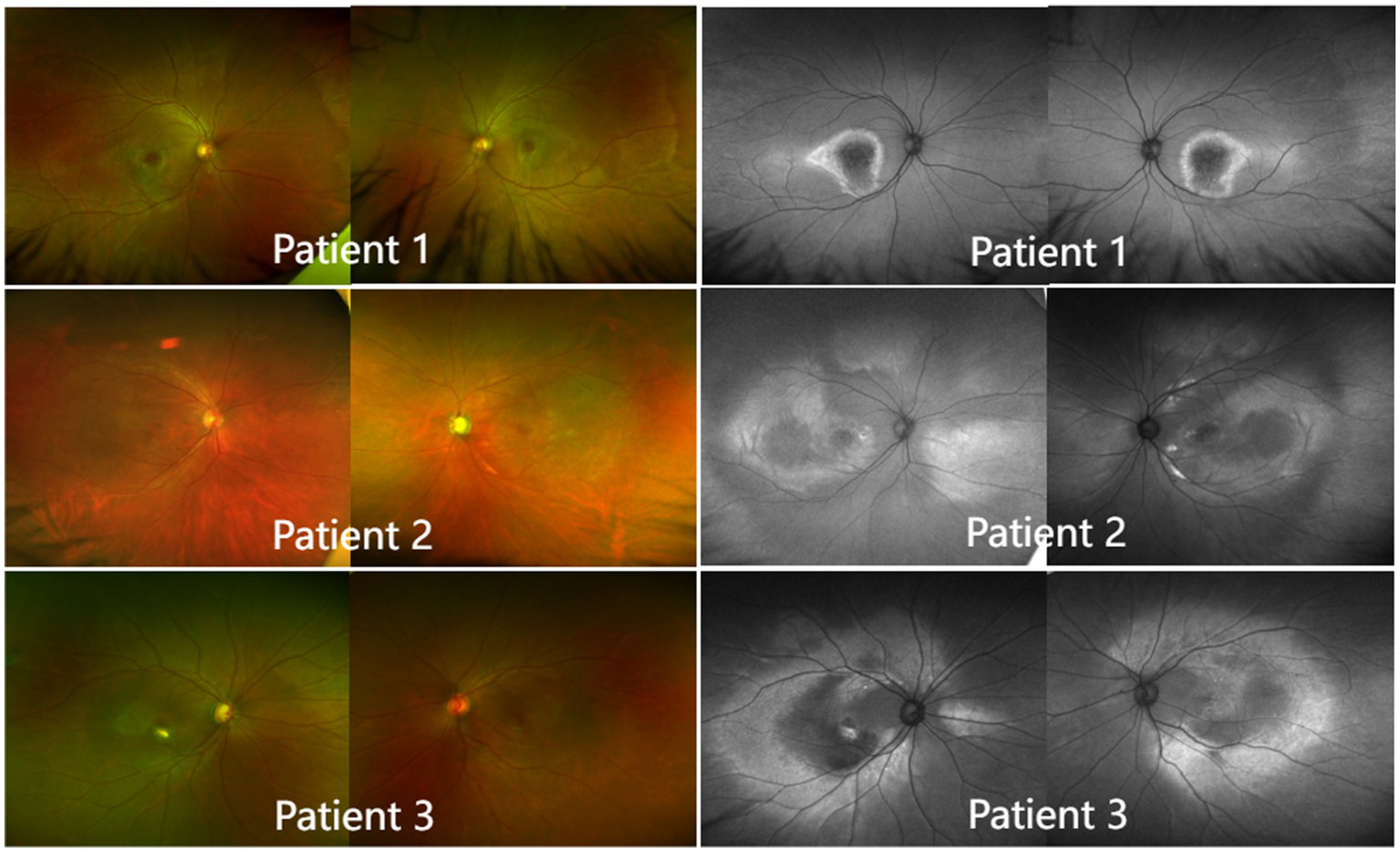 Retinal images of three patients captured in color and black-and-white. The left panels show color images with visible optic discs and blood vessels. The right panels display corresponding black-and-white images highlighting retinal structures and possible abnormalities. Each row represents a different patient, labeled Patient 1, Patient 2, and Patient 3.