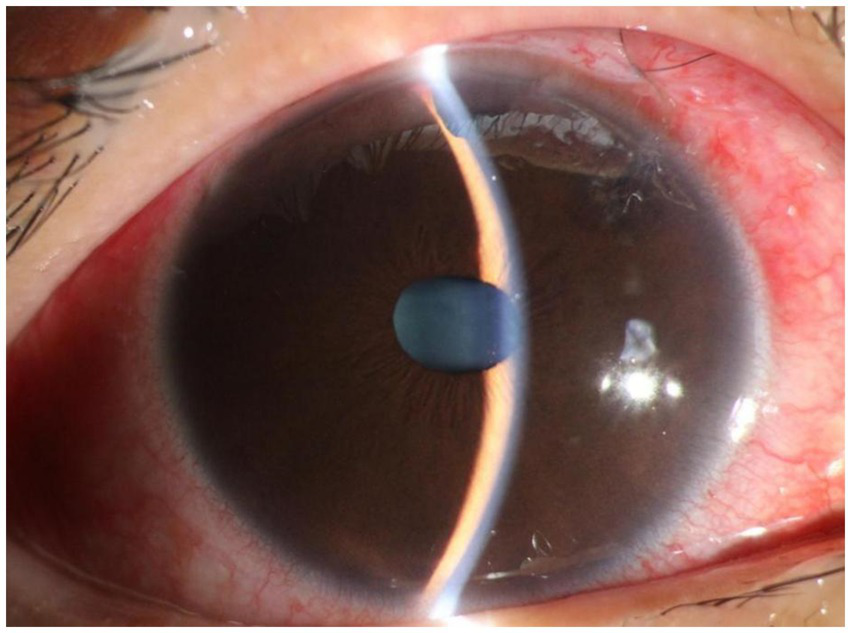 Close-up of a human eye showing a brown iris, a detailed texture, and the pupil in the center. The sclera is slightly bloodshot, and there is light reflection on the surface of the eye.