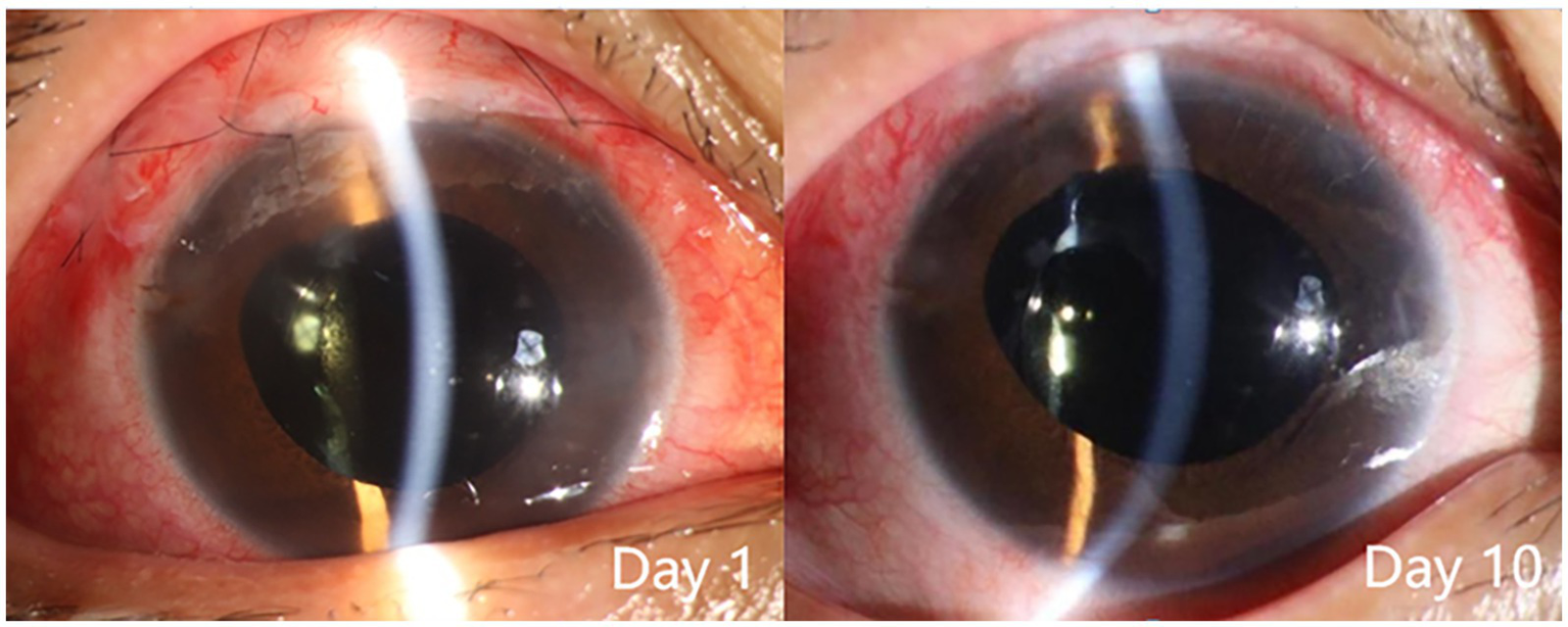 Close-up images of an eye, illustrating corneal healing over time. The first image, labeled "Day 1," shows significant redness and inflammation around the eye. The second image, labeled "Day 10," shows reduced redness and a clearer corneal surface, indicating healing progress.