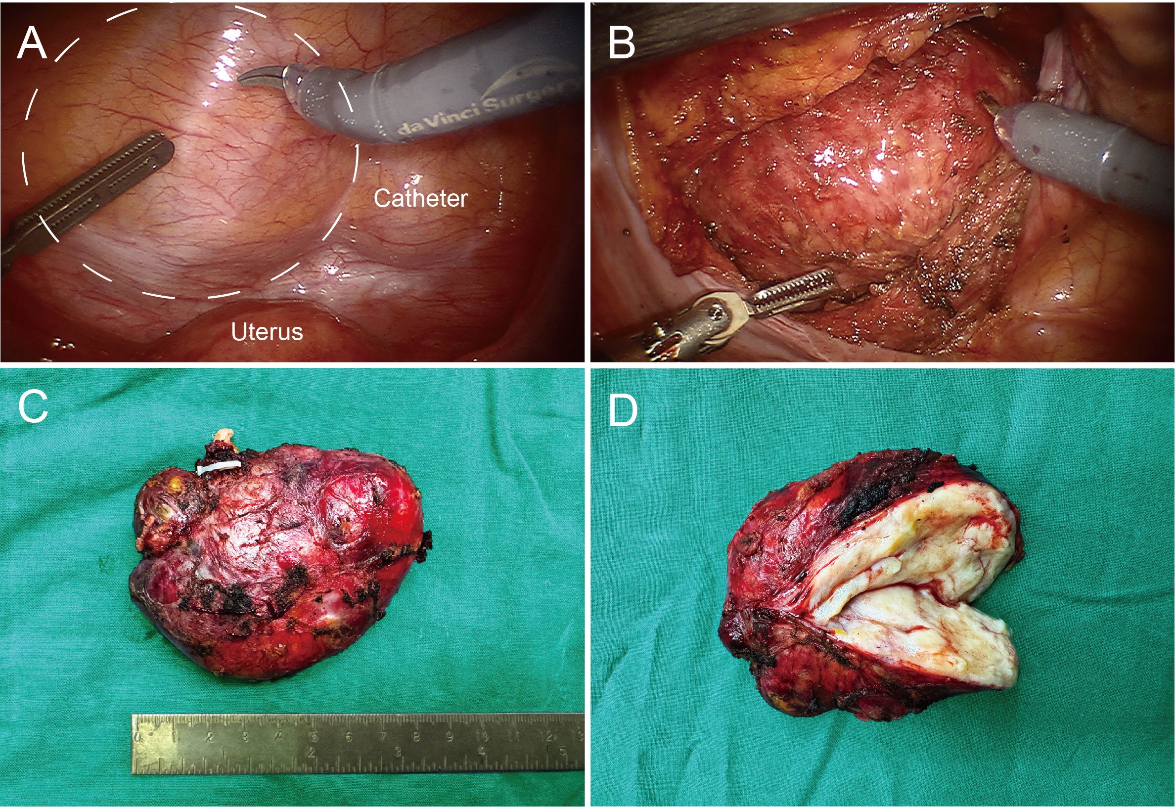 Four-panel image showing surgical and pathological views. Panel A: Surgical instruments near the uterus, labeled with a catheter. Panel B: Surgical view of the uterus with instruments. Panel C: Removed tissue mass on a green cloth beside a ruler for scale. Panel D: Cross-section of the removed tissue showing inner texture and composition.