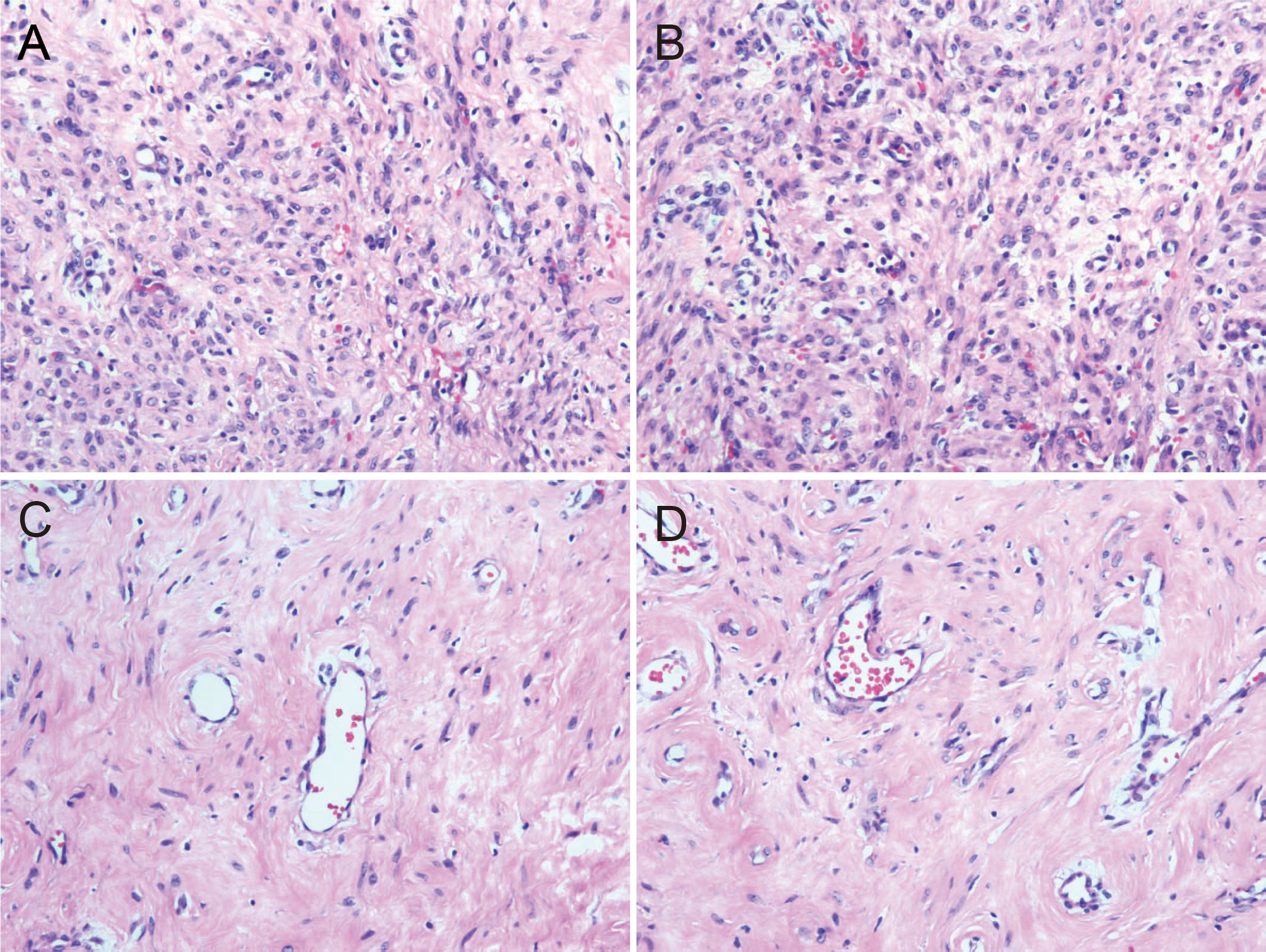 Histological slides of tissue samples in four panels labeled A, B, C, and D. Panels A and B show densely packed cells with prominent dark nuclei. Panels C and D show more fibrous tissue with fewer cells and visible blood vessels. Each panel presents a different tissue pattern and cell arrangement, suggesting a comparison of different histological features.