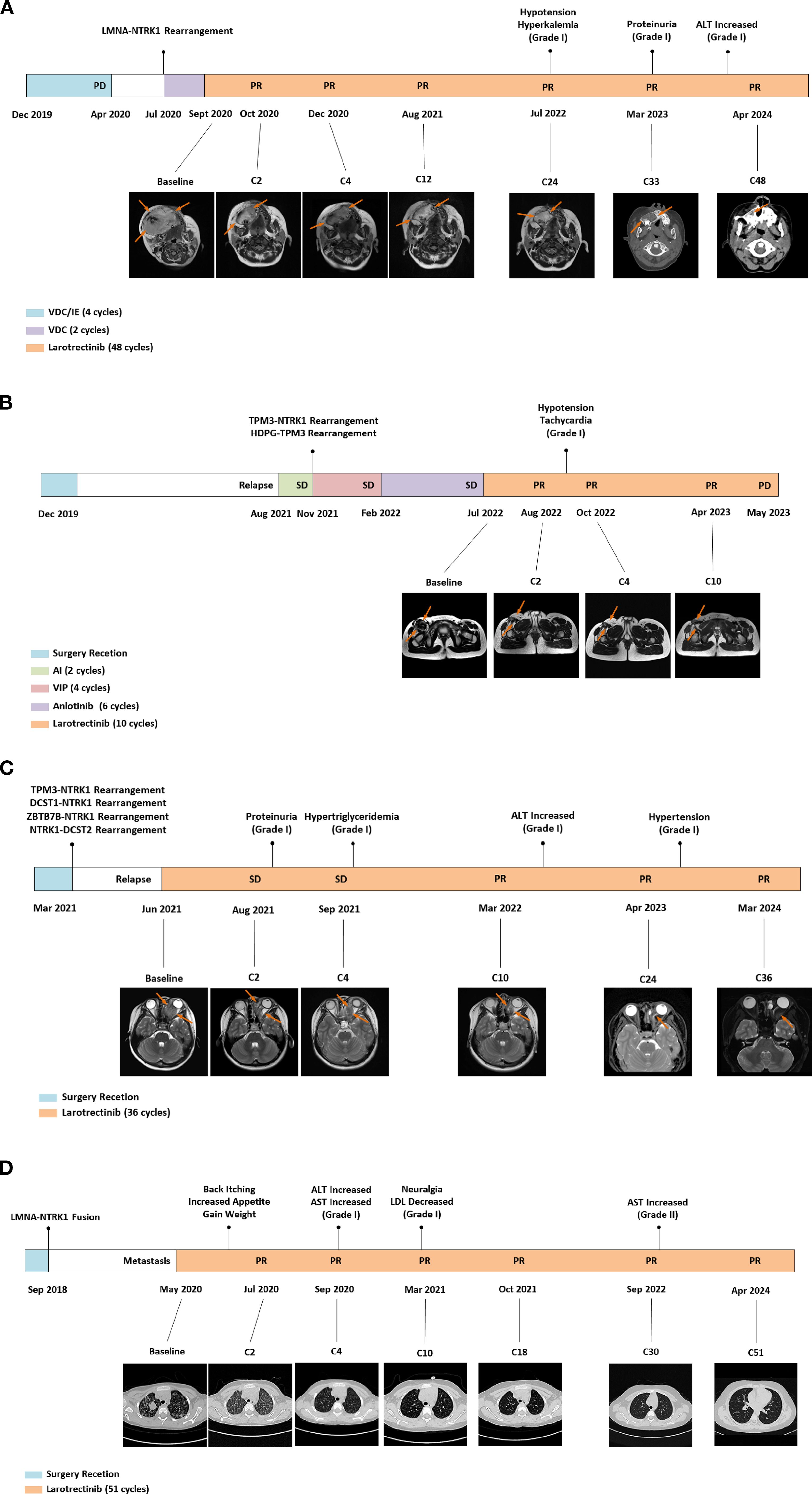 Four panels (A, B, C, D) depict treatment timelines with MRI scans for different patients, showing rearrangements or fusion of genes (e.g., LMNA-NTRK1). Each timeline includes periods of disease progression (PD), partial response (PR), and stable disease (SD). Clinical interventions like surgery, chemotherapy, targeted therapy (larotrectinib), and adverse events (e.g., hypertension, proteinuria) are noted. MRI images display tumor changes over time, indicated by orange arrows. Each panel has timelines from December 2019 to 2024, demonstrating treatment cycles and outcomes for various genetic rearrangements.