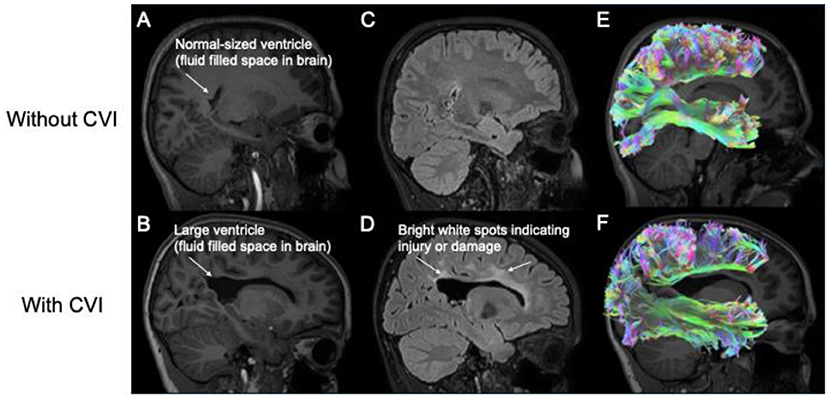Six MRI images showing the possible differences in the brain between people with CVI (bottom row) and without CVI (top row). In the first column, image B shows the large ventricles that some children with CVI may have. In the middle column, image D shows the bright spots reflecting damaged white matter that some children with CVI may have. These bright spots are not typically found in a child’s brain (image C). In the right column, image F shows how the brain fibre pathways may be reduced in some children with CVI as compared to the typical pathways shown in image E.