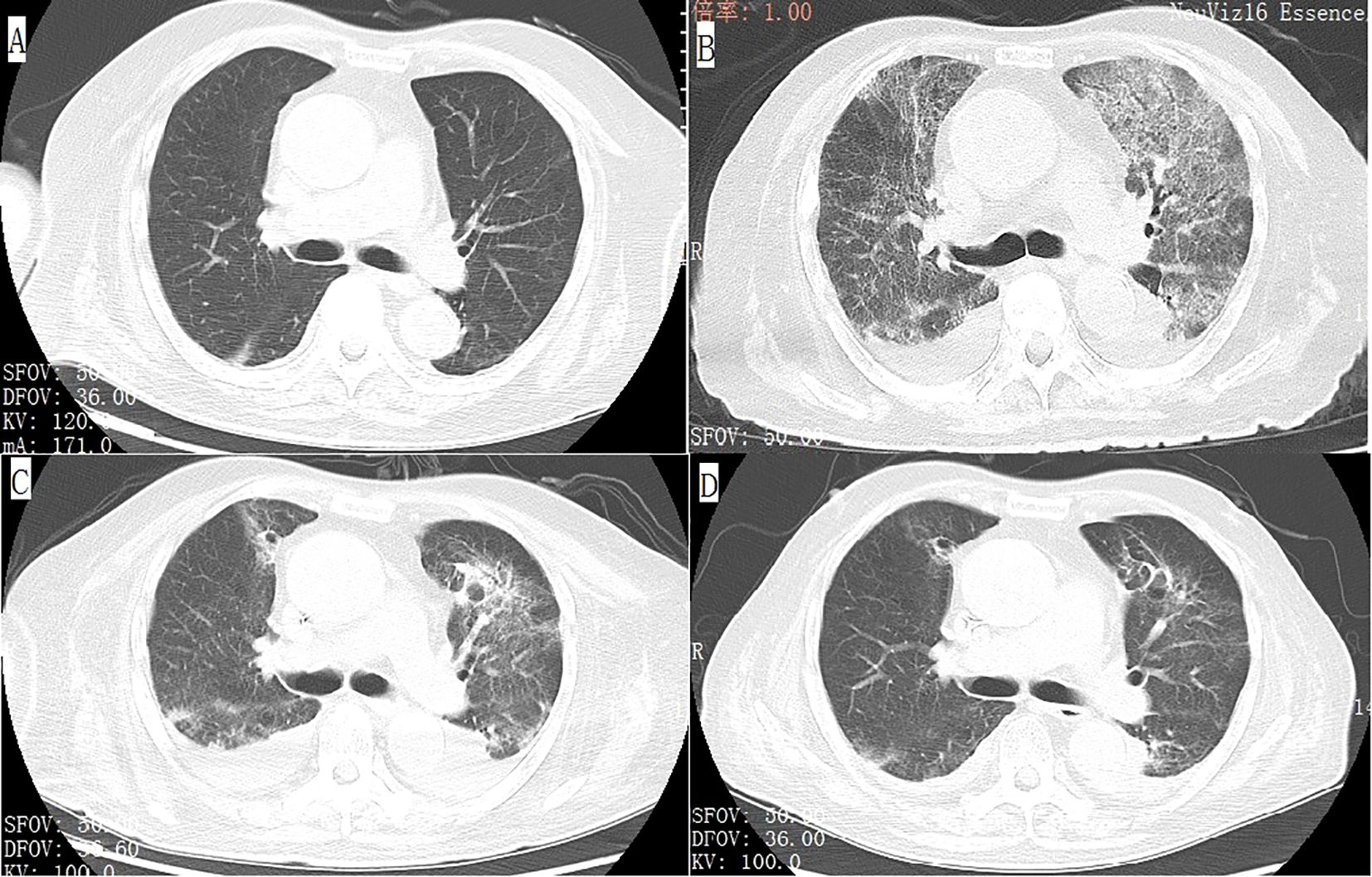 CT scan showing four images of a chest. Panel A presents a clear lung appearance. Panels B, C, and D display increased lung density with patchy opacities, indicating potential respiratory issues.