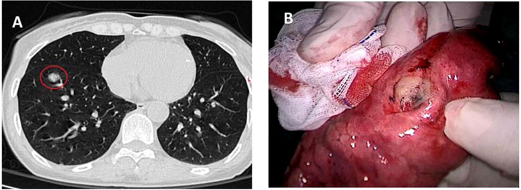 Image A shows a CT scan of a chest, with a round lesion circled in red on the left side of the lung. Image B shows a close-up view of a lesion on a resected lung tissue, held by gloved hands, partially covered with gauze.