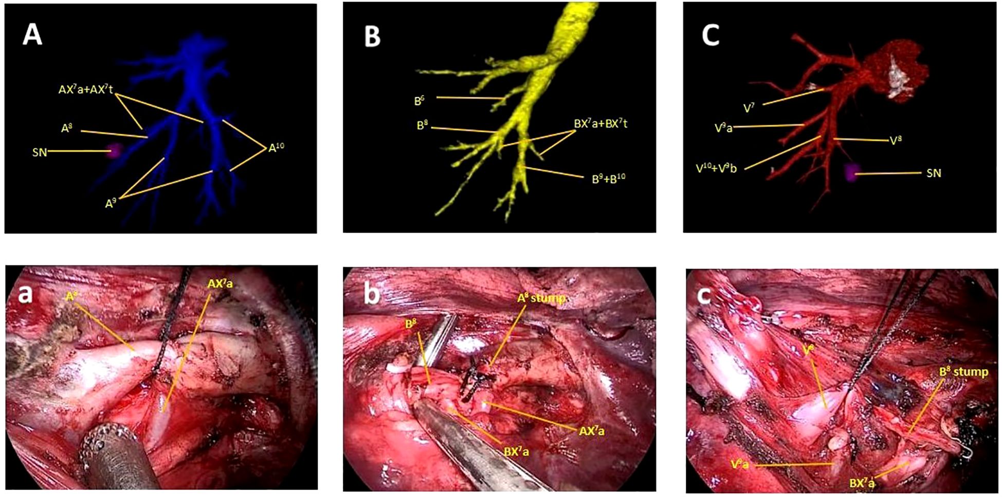The image consists of two rows of labeled anatomical diagrams and surgical photographs. The top row shows digital models of arterial (A), bronchial (B), and venous (C) structures with labels like AX7, A8, B6, and V7b. The bottom row displays corresponding intraoperative images labeled a, b, and c, highlighting specific anatomical features like A8 stump, BX’a, and V’a.