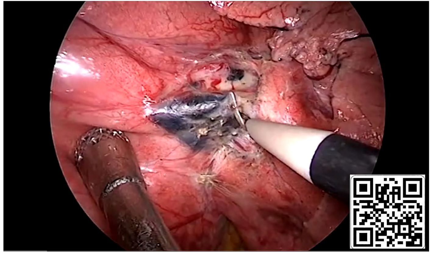 Surgical view inside a body cavity shows an exposed internal area with medical instruments. The tissue appears red and moist, indicating a live surgical environment. A QR code is present in the lower right corner.