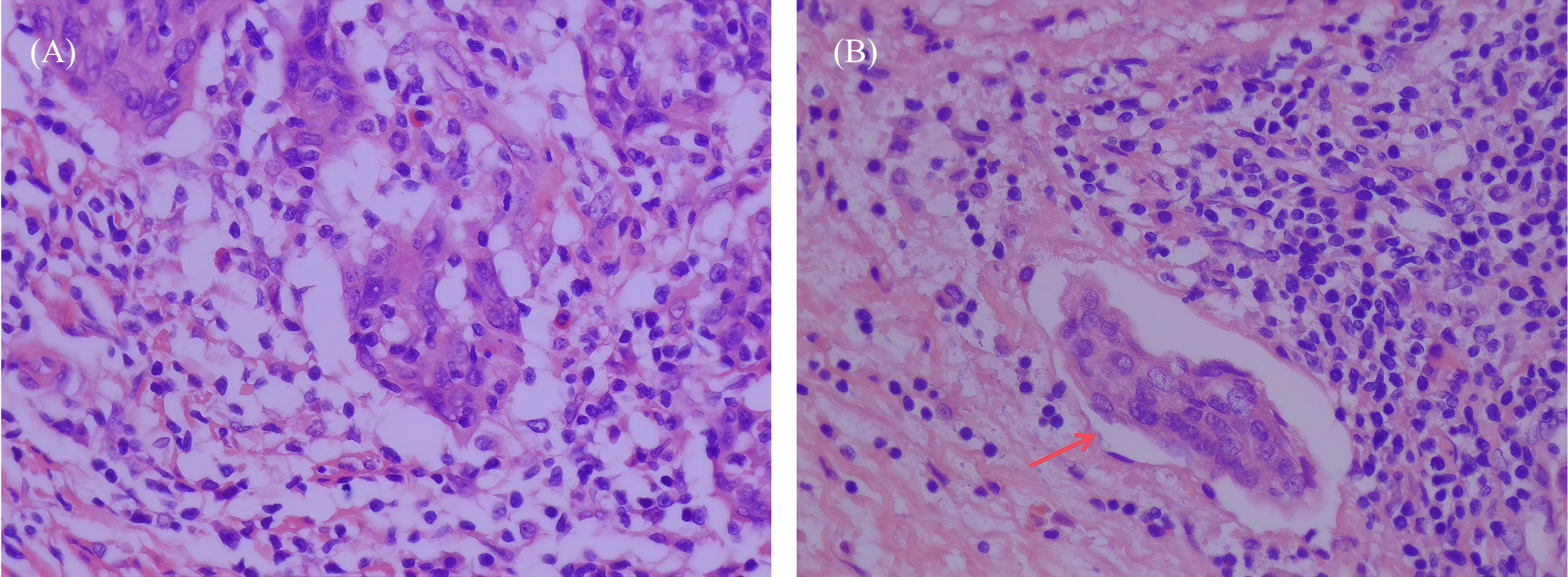 Two microscopic images labeled A and B show human tissue stained in purple and pink hues. Image A features dense clusters of cells. Image B highlights a formation resembling a granuloma marked with a red arrow, indicating a notable structure within a more dispersed cellular background.
