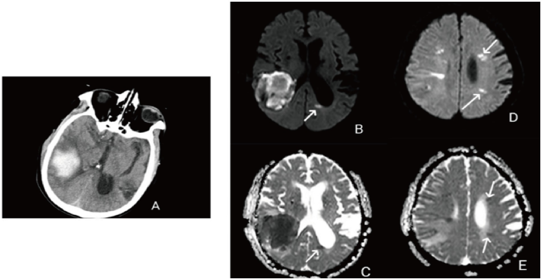 CT and MRI scans show different brain abnormalities. Image A shows a bright area on a CT scan. Images B, C, D, and E display MRI scans with contrast variations; arrows highlight significant changes in brain tissue.