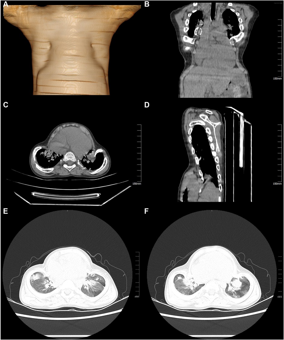 Panel of medical imaging scans displaying various views of a torso. Image A shows a 3D rendered anterior torso view; B is a coronal CT scan highlighting the chest cavity; C is an axial CT slice of the thorax; D presents a sagittal view; E and F show detailed axial CT scans focusing on lung structures.Panel of medical imaging scans displaying various views of a torso. Image A shows a 3D rendered anterior torso view; B is a coronal CT scan highlighting the chest cavity; C is an axial CT slice of the thorax; D presents a sagittal view; E and F show detailed axial CT scans focusing on lung structures.