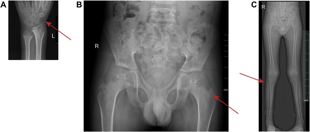 x-ray images showing three panels: (A) an x-ray of a left forearm and wrist with an arrow pointing to a bone area; (B) a pelvic x-ray with an arrow highlighting the hip region; (C) a full leg x-ray with arrows indicating points on the femur and tibia.