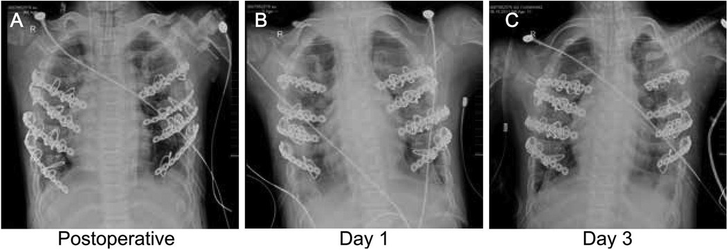 Three chest x-rays show the progression of rib cage stabilization over time. The first image is postoperative, the second on day one, and the third on day three. Metal plates and wires are visible securing the ribs, indicating surgical intervention.
