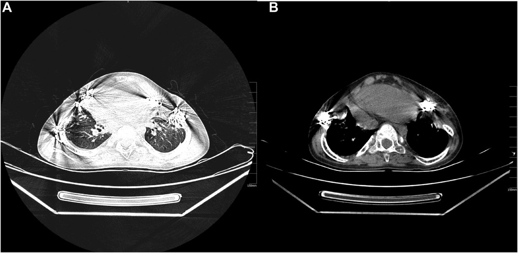 CT scans in two panels. Panel A on the left shows a cross-sectional thoracic view with clear lungs and visible vertebrae. Panel B on the right displays another cross-sectional view with less defined lung areas, possibly due to variations in imaging settings or patient condition. Both images include measurement markers.