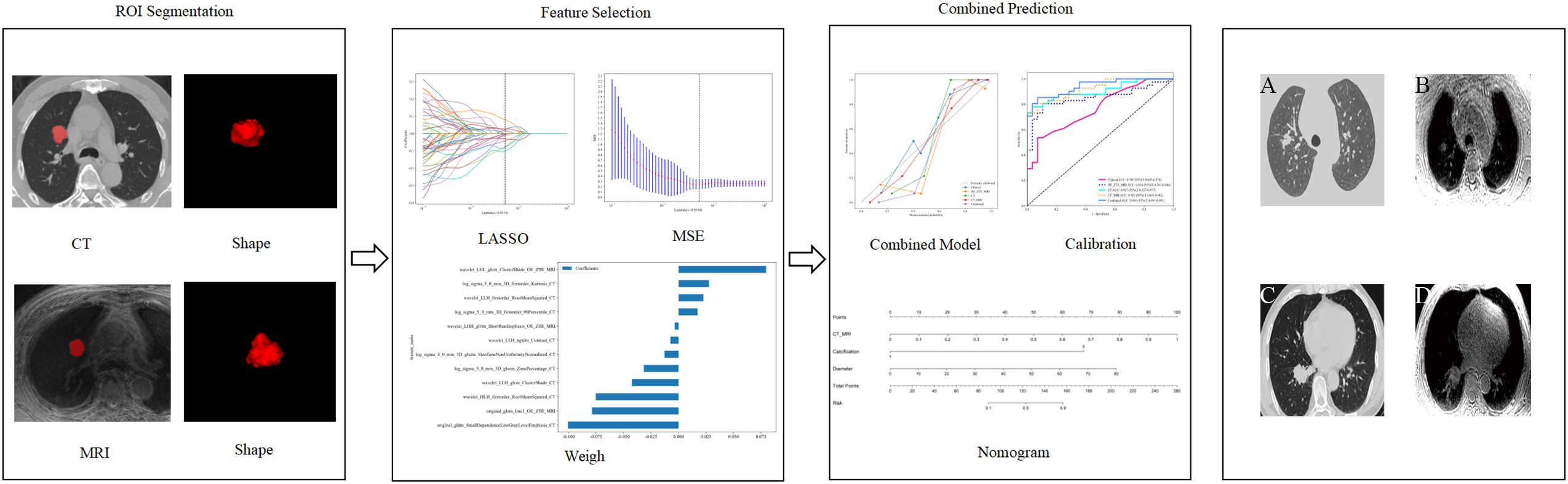 Diagram showing a process for analyzing medical images. The first section, “ROI Segmentation,” displays CT and MRI scans with highlighted regions. The next section, “Feature Selection,” includes LASSO and MSE plots, and a chart of feature weights. The final section, “Combined Prediction,” shows a combined model plot, a calibration graph, and a nomogram for risk assessment.