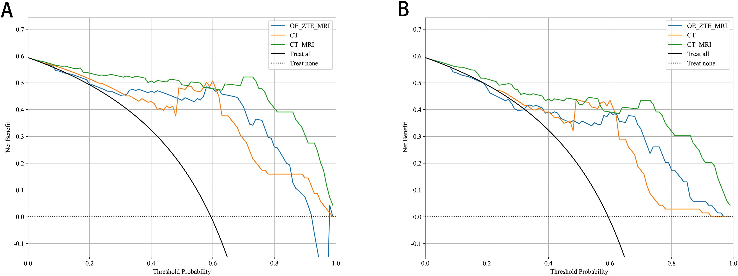 Two graphs labeled A and B compare net benefit against threshold probability for different models: OE_ZTE_MRI (blue), CT (orange), CT_MRI (green), with reference lines for “Treat all” (black) and “Treat none” (dashed). Both graphs display similar trends, showing variations in net benefit across threshold probabilities from 0 to 1.