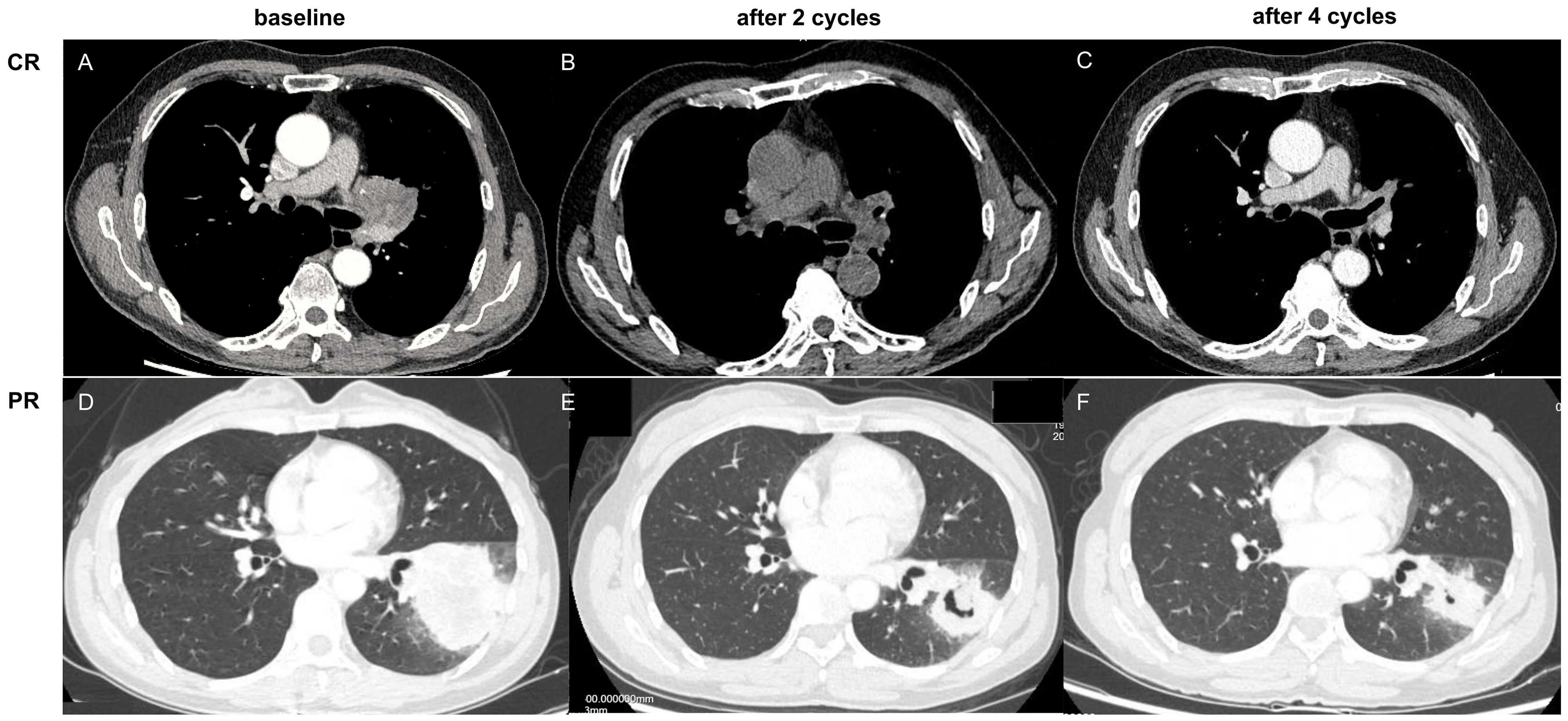 CT scans showing two panels of lung images, labeled CR (complete response) and PR (partial response), each with three stages: baseline, after two cycles, and after four cycles. The CR row shows changes over treatment cycles with images A to C. The PR row demonstrates similar progression with images D to F.