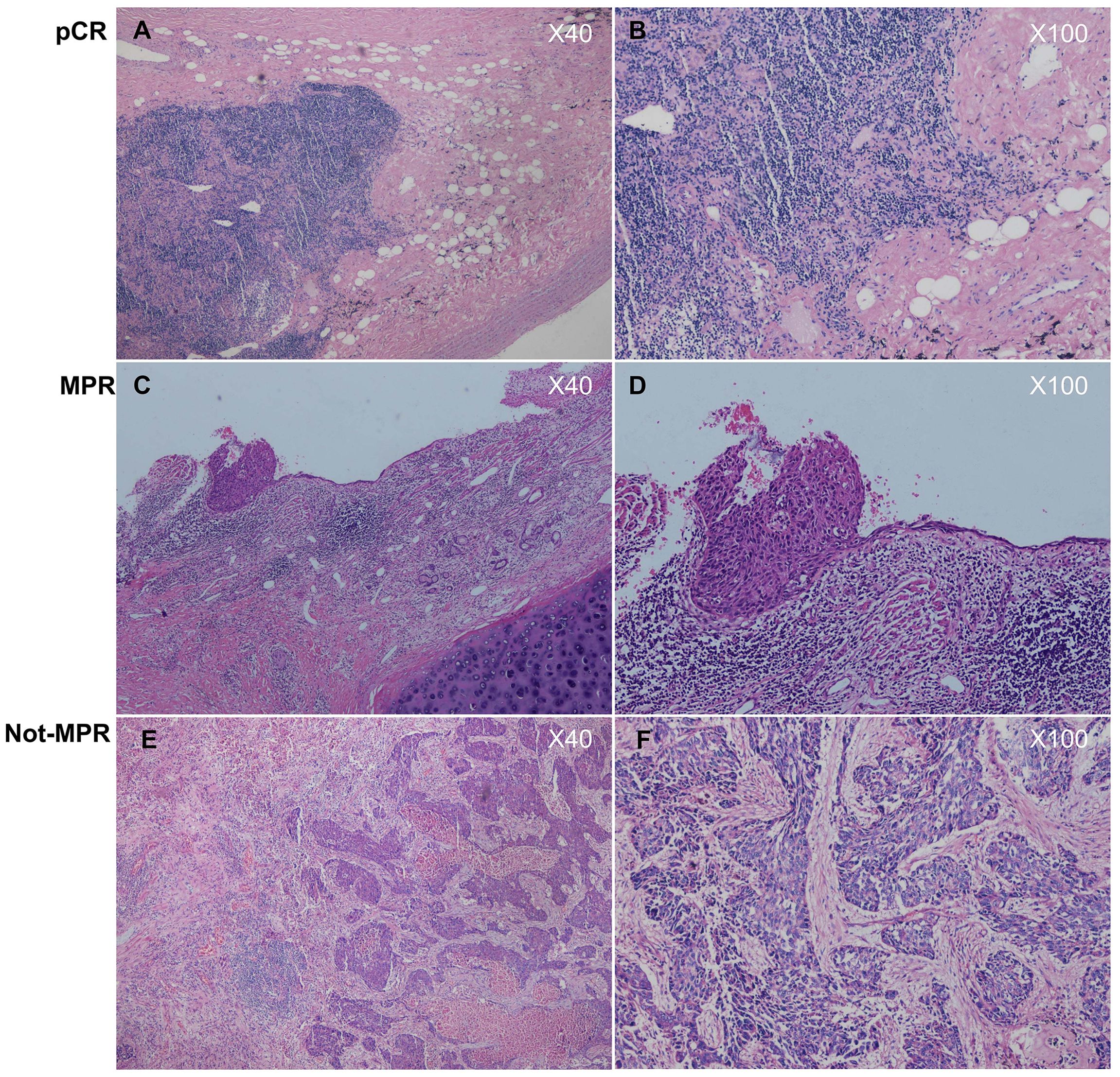 Histological images showing tissue samples under different magnifications. Panels A and B labeled as pCR with magnifications of 40x and 100x show varying cellular structures. Panels C and D labeled as MPR have similar magnifications highlighting distinct tissue formations. Panels E and F labeled as Not-MPR display complex patterns and cell densities at 40x and 100x magnifications.