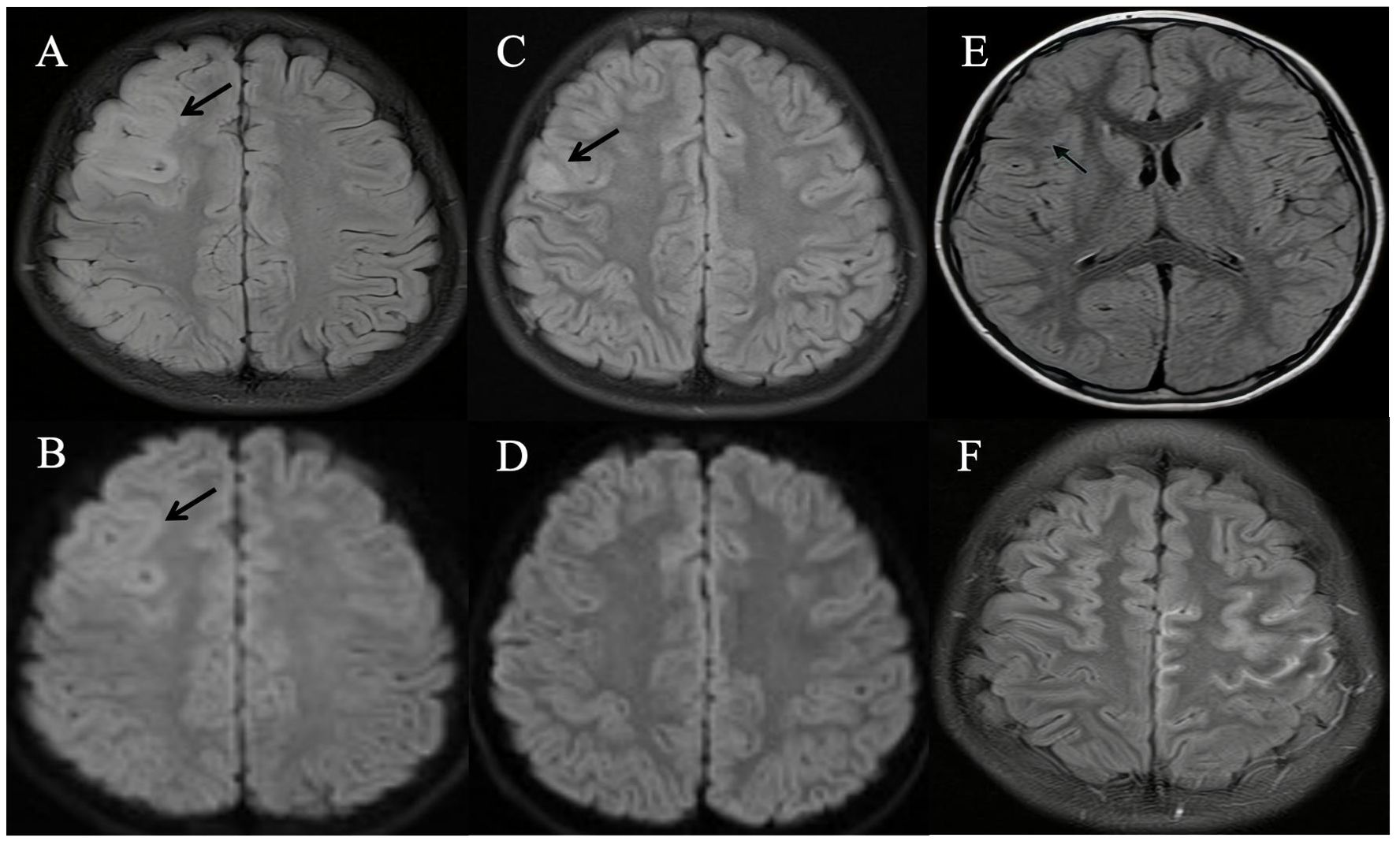 MRI brain scans in a 3x2 grid labeled A to F. Images A, B, and C show similar views with arrows pointing to specific brain areas, likely indicating abnormalities. Images D, E, and F show other brain sections without arrows. The scans highlight different brain features and structures.