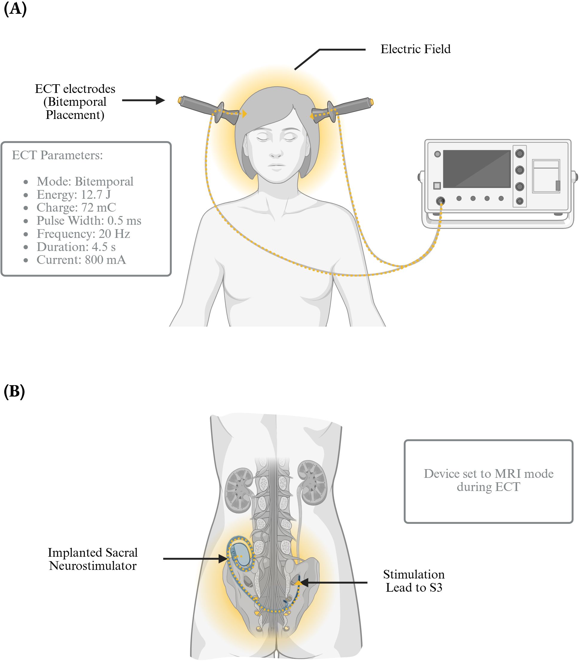 Illustration of Electroconvulsive Therapy (ECT) and a Sacral Neurostimulator. The ECT setup includes bitemporal electrodes on a patient's head connected to a machine with specified parameters: mode (bitemporal), energy (12.7 joules), charge (72 mC), pulse width (0.5 milliseconds), frequency (20 Hz), duration (4.5 seconds), and current (800 mA). Below, an implanted sacral neurostimulator with a stimulation lead to the S3 nerve is shown. The device is set to MRI mode during ECT.