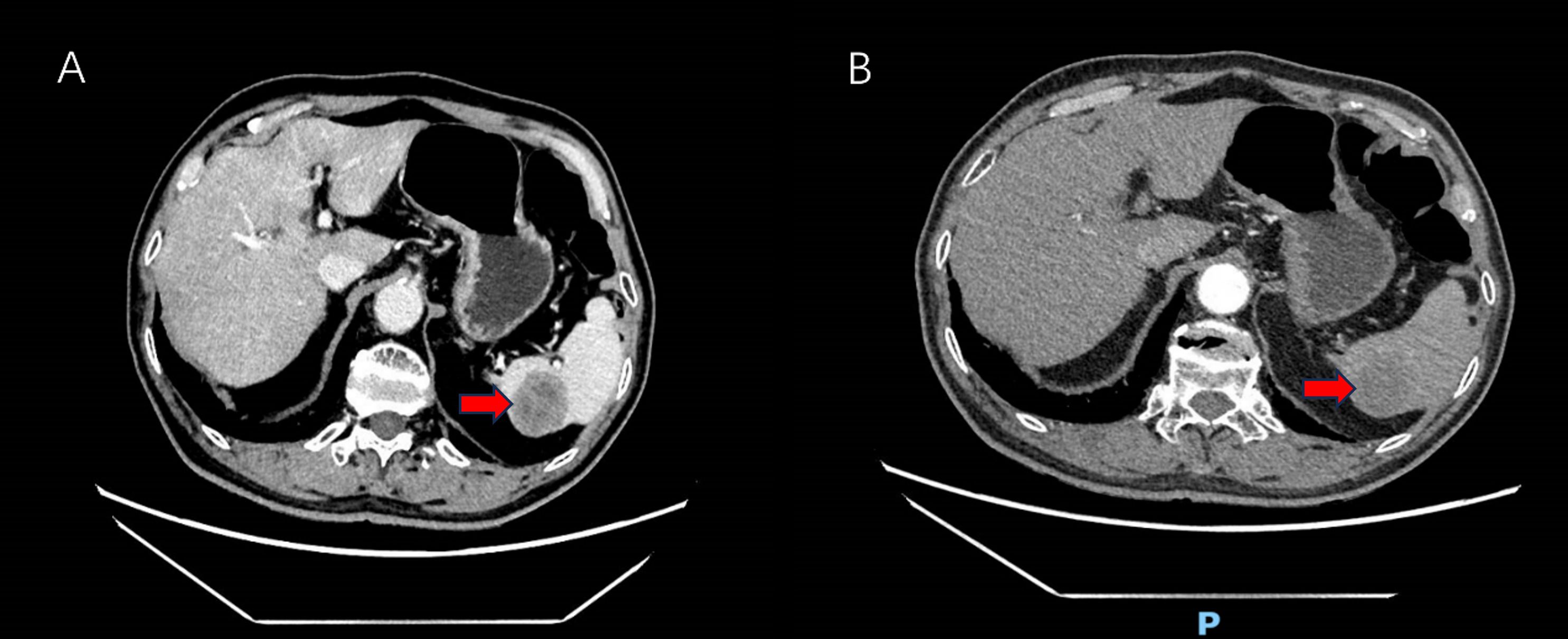 CT scan showing two panels labeled A and B of the abdominal area. Panel A highlights a bright area with a red arrow pointing to it, indicating a specific detail. Panel B shows a similar view, with a red arrow pointing to a darker region, suggesting another point of interest. The scans exhibit differences in contrast and tissue densities.