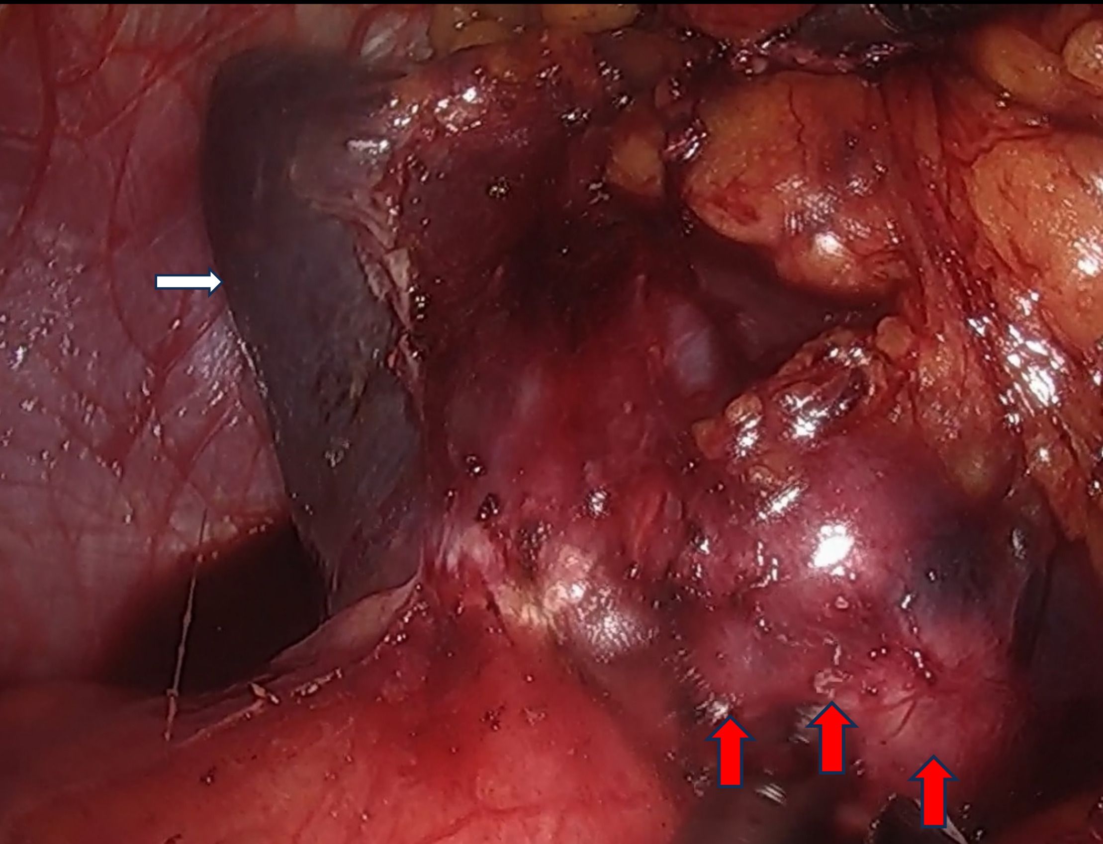 A close-up image showing a dark mass in the abdomen with a white arrow pointing to its edge on the left. Three red arrows at the bottom highlight additional areas of interest or lesions. The surrounding tissue appears irregular and red, suggesting inflammation or pathology.