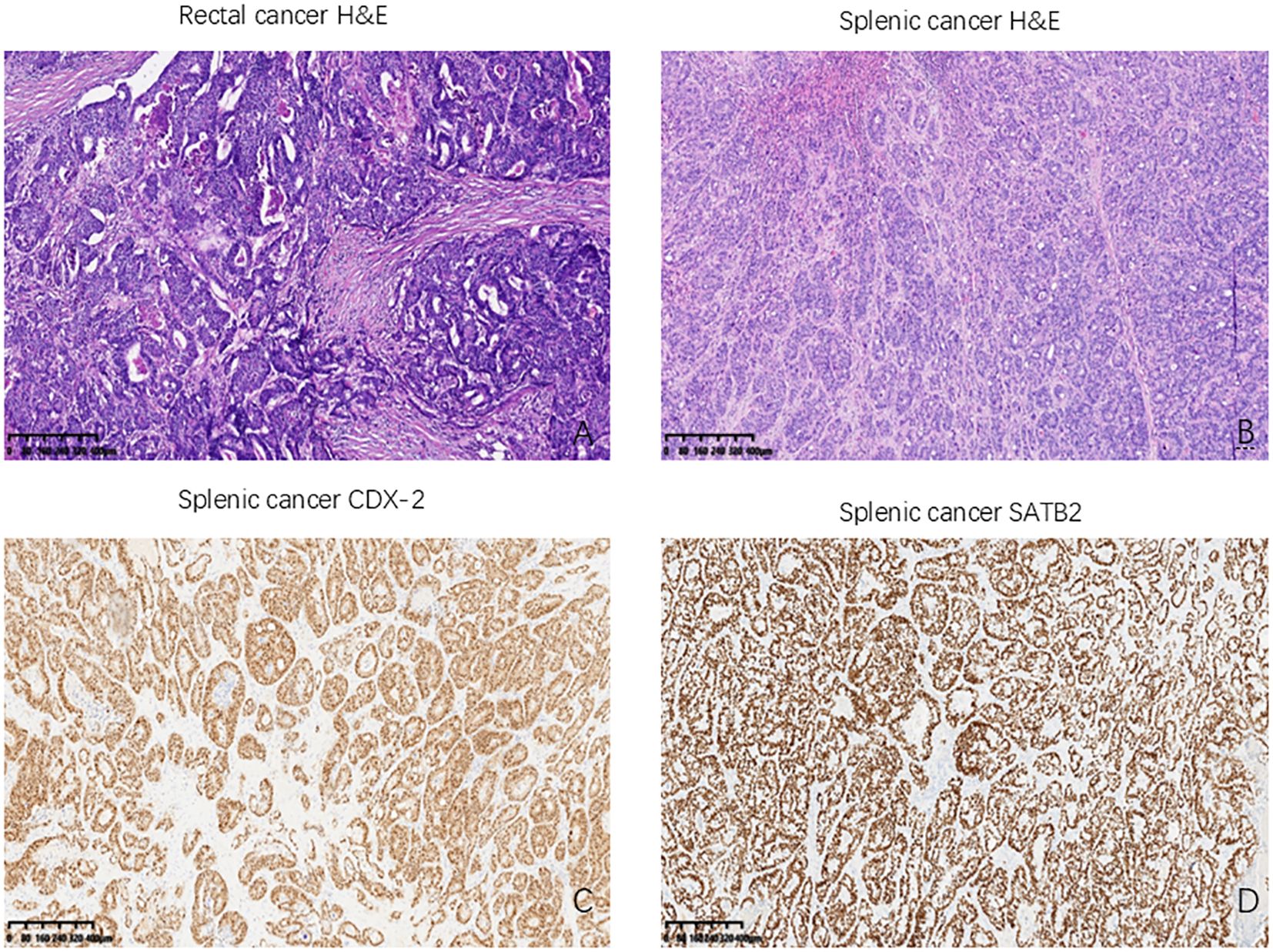 Histological slides showing two distinct cancer types. Panel A shows rectal cancer stained with H&E, featuring dense cell clusters. Panel B depicts splenic cancer with a similar stain, displaying a more diffuse pattern. Panel C illustrates splenic cancer with CDX-2 staining, highlighting cellular details. Panel D shows splenic cancer stained with SATB2, revealing a distinct cellular pattern.
