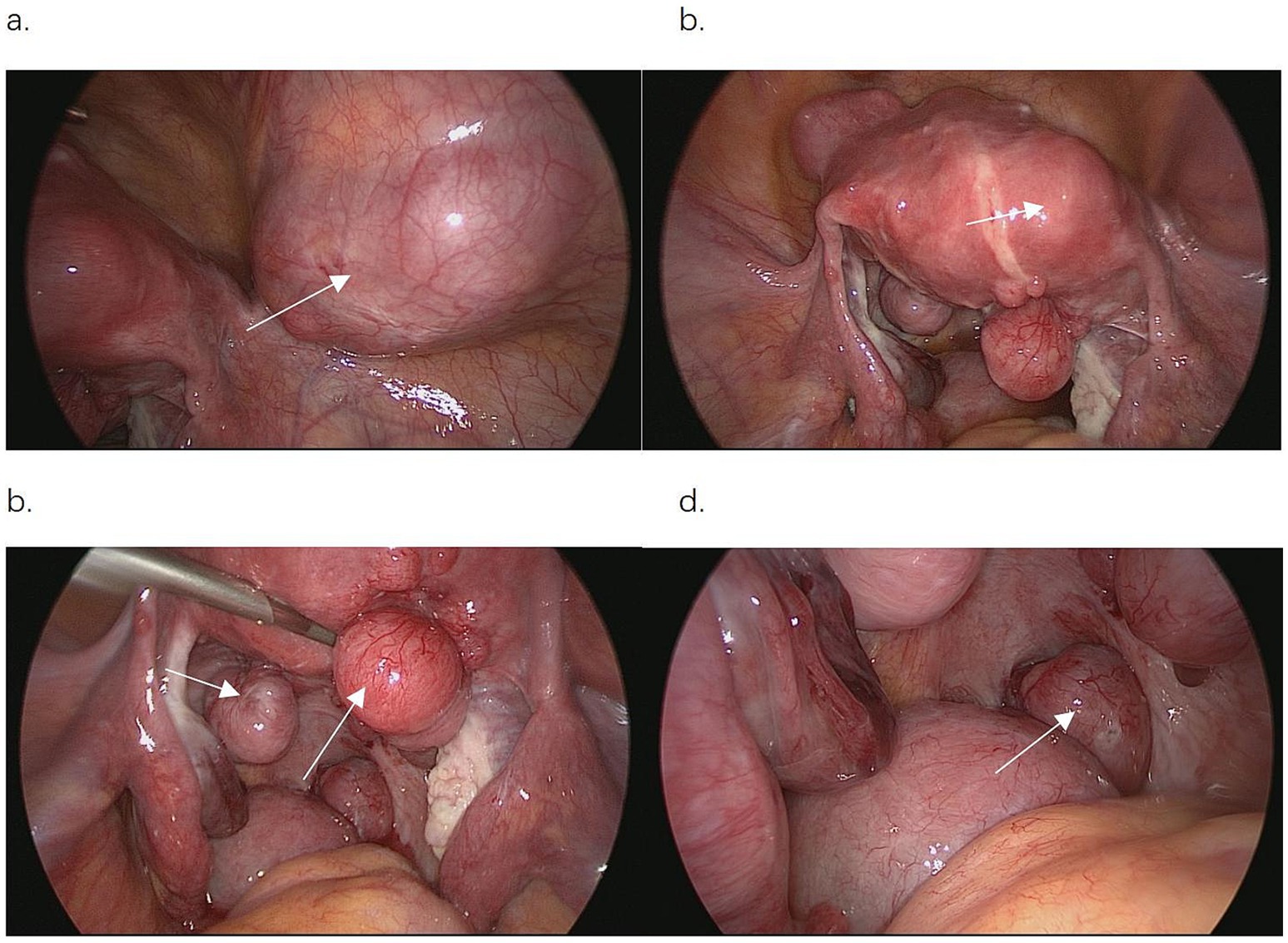 Laparoscopic images depict various stages of an ovarian cyst. Image a shows a bulging cyst with associated vessels. Image b features the cyst with evidence of adhesion or lesion. Image c highlights the cyst being manipulated with a surgical instrument. Image d reveals the cyst with less visible surrounding structures.