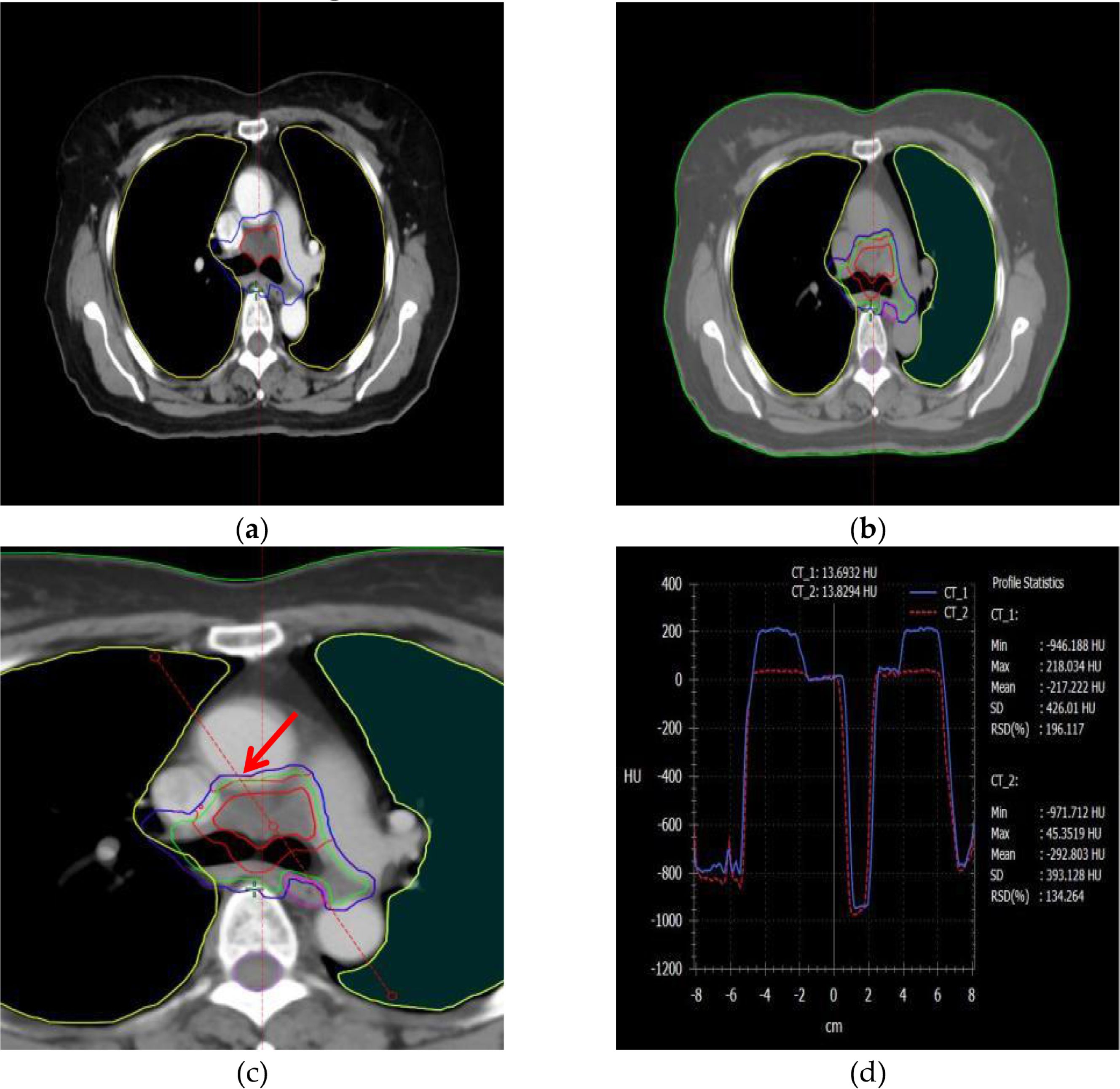 Four-panel image showing CT scans and analysis. Panel (a) displays a transverse chest CT scan with various colored outlines indicating different tissues. Panel (b) shows a similar CT scan with highlighted regions and additional shading. Panel (c) presents a closer view of the chest with a red arrow pointing to a specific area, emphasizing the outlined and shaded structures. Panel (d) features a graph of Hounsfield units (HU) versus centimeters, displaying two lines, labeled CT_1 and CT_2, with profile statistics on the right.