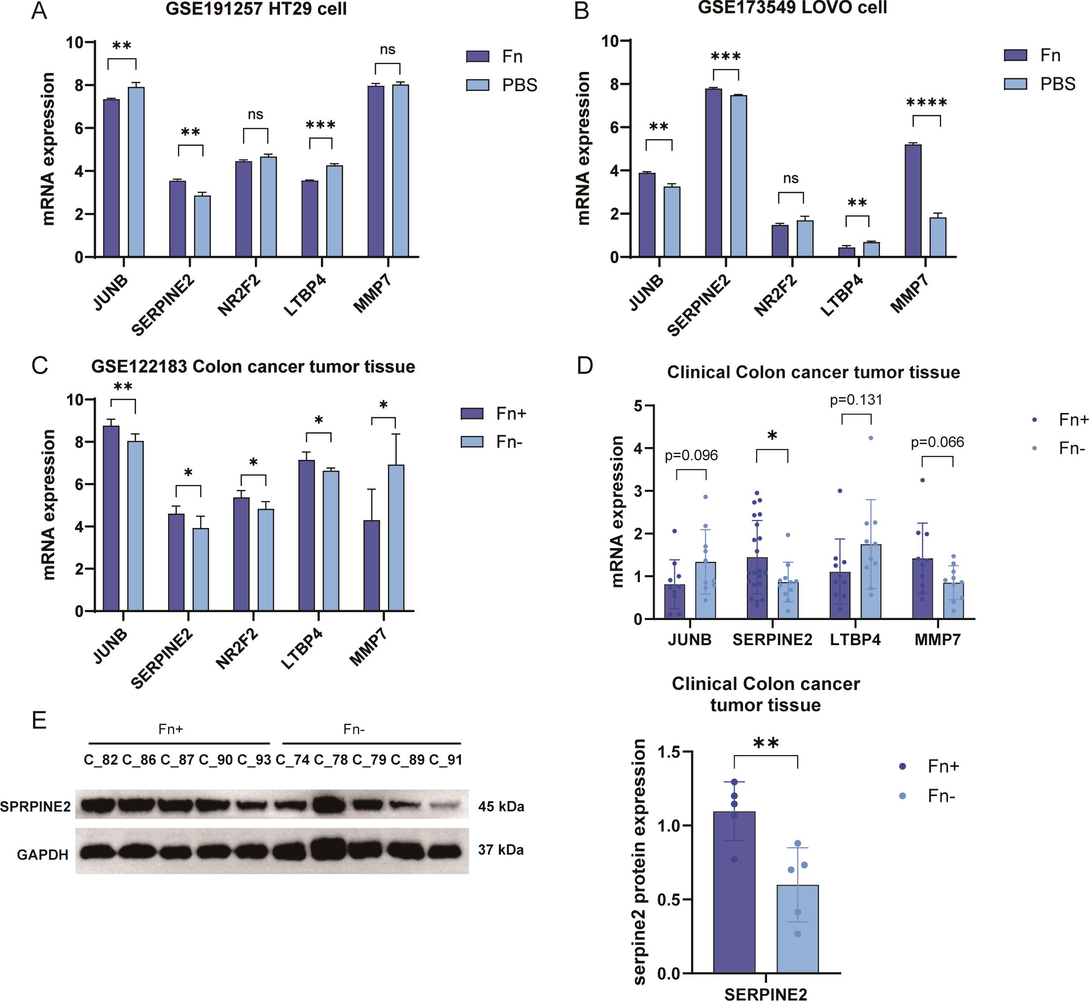 Bar graphs and a Western blot image analyze gene expression levels. Panels A, B, and C show mRNA expression for genes JUNB, SERPINE2, NRF2, LTBP4, and MMP7 in different cell lines and colon cancer tumor tissue, with statistical significance indicated. Fn conditions are compared against controls. Panel D shows clinical colon cancer tissue mRNA expression with p-values. The Western blot in panel E depicts SERPINE2 protein expression in Fn+ and Fn- conditions, with a bar graph summarizing the data below, highlighting significant differences.