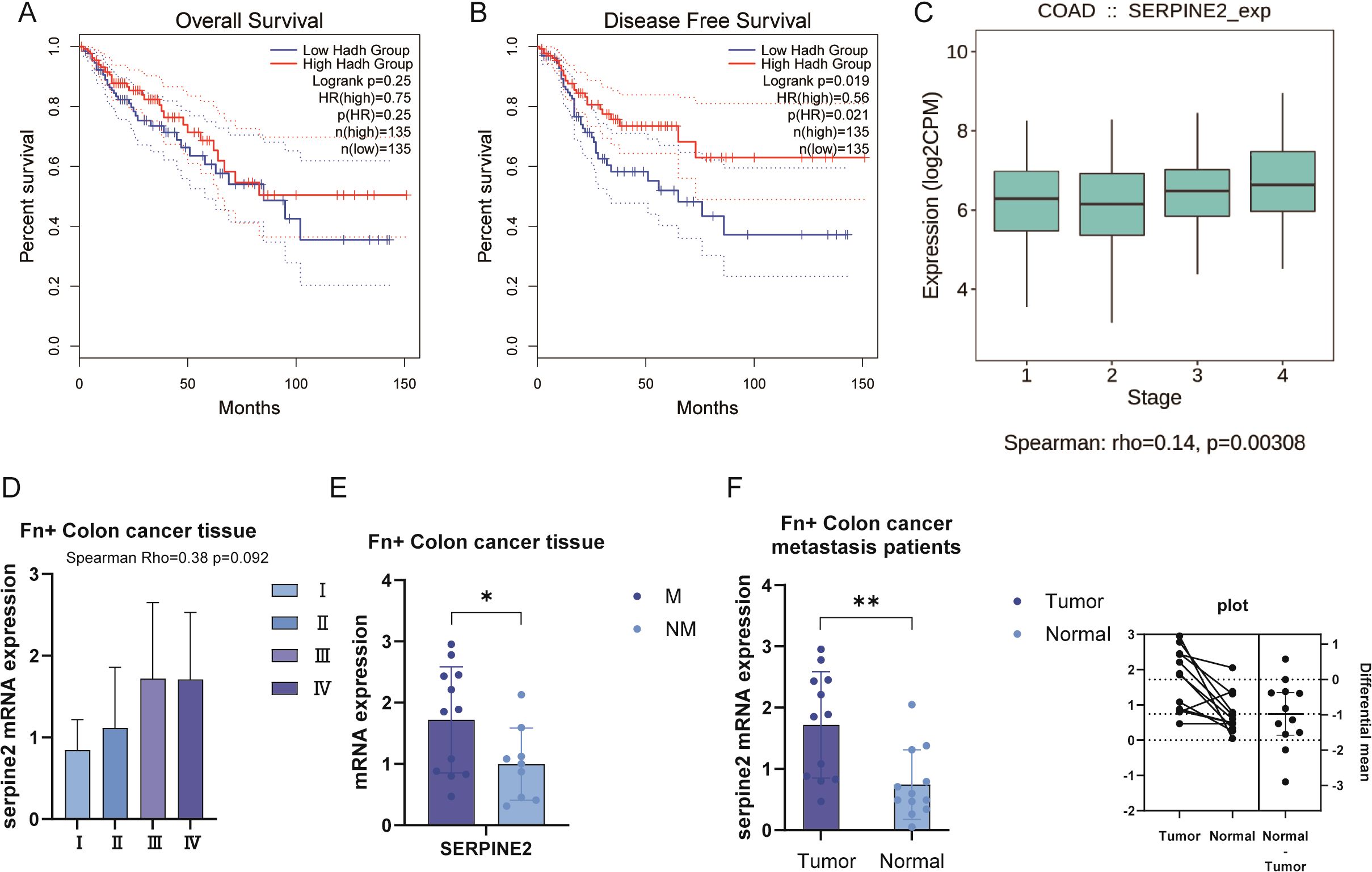 Graphs present data on colon cancer. Panel A shows overall survival curves for high and low Hadh groups, indicating survival over time. Panel B depicts disease-free survival curves. Panel C displays box plots of SERPINE2 expression across cancer stages. Panel D illustrates serpine2 mRNA expression in colon cancer tissues across four stages. Panel E compares SERPINE2 mRNA expression, highlighting tumor versus normal differences, with significance marked by an asterisk. Panel F contrasts mRNA expression in colon cancer metastasis patients, showcasing tumor versus normal, with significance indicated by double asterisks.