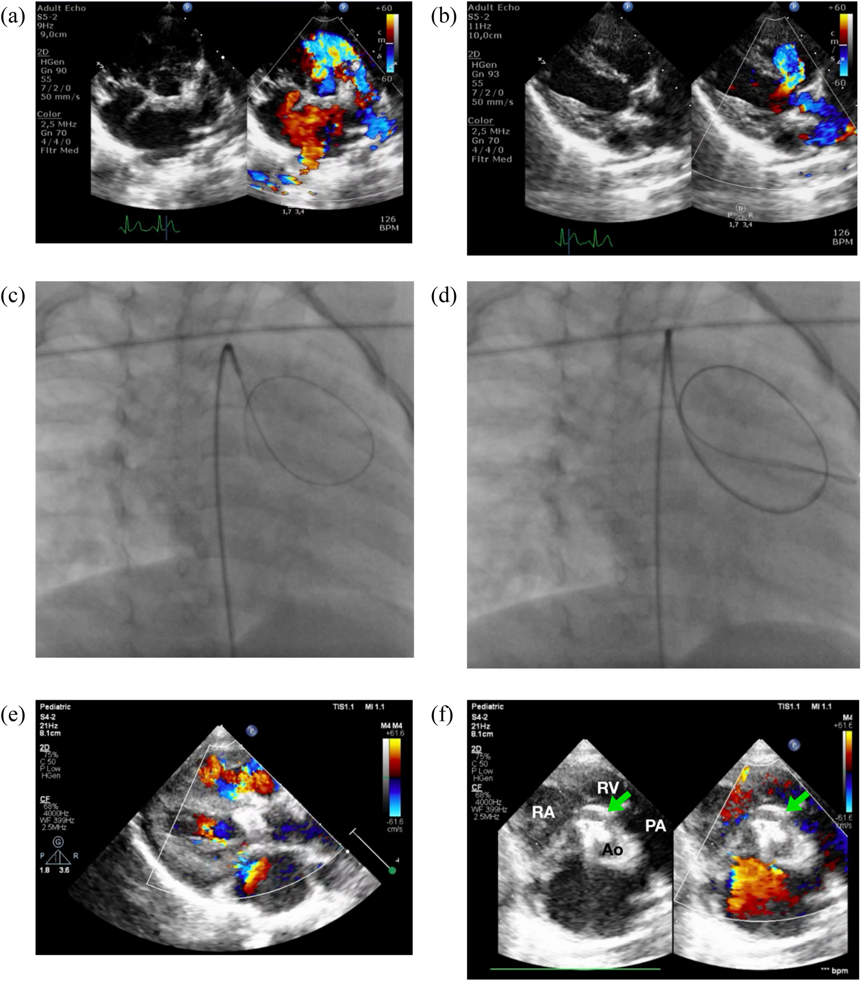 (a) Echocardiographic image showing color Doppler flow in a heart, indicating blood movement. (b) Similar echocardiographic image with color Doppler. (c) X-ray of a heart catheterization, showing a catheter loop. (d) Another X-ray view of catheter placement. (e) Pediatric echocardiogram with color Doppler illustrating blood flow. (f) Pediatric echocardiogram labeling right ventricle, pulmonary artery, and aorta with color Doppler flow.