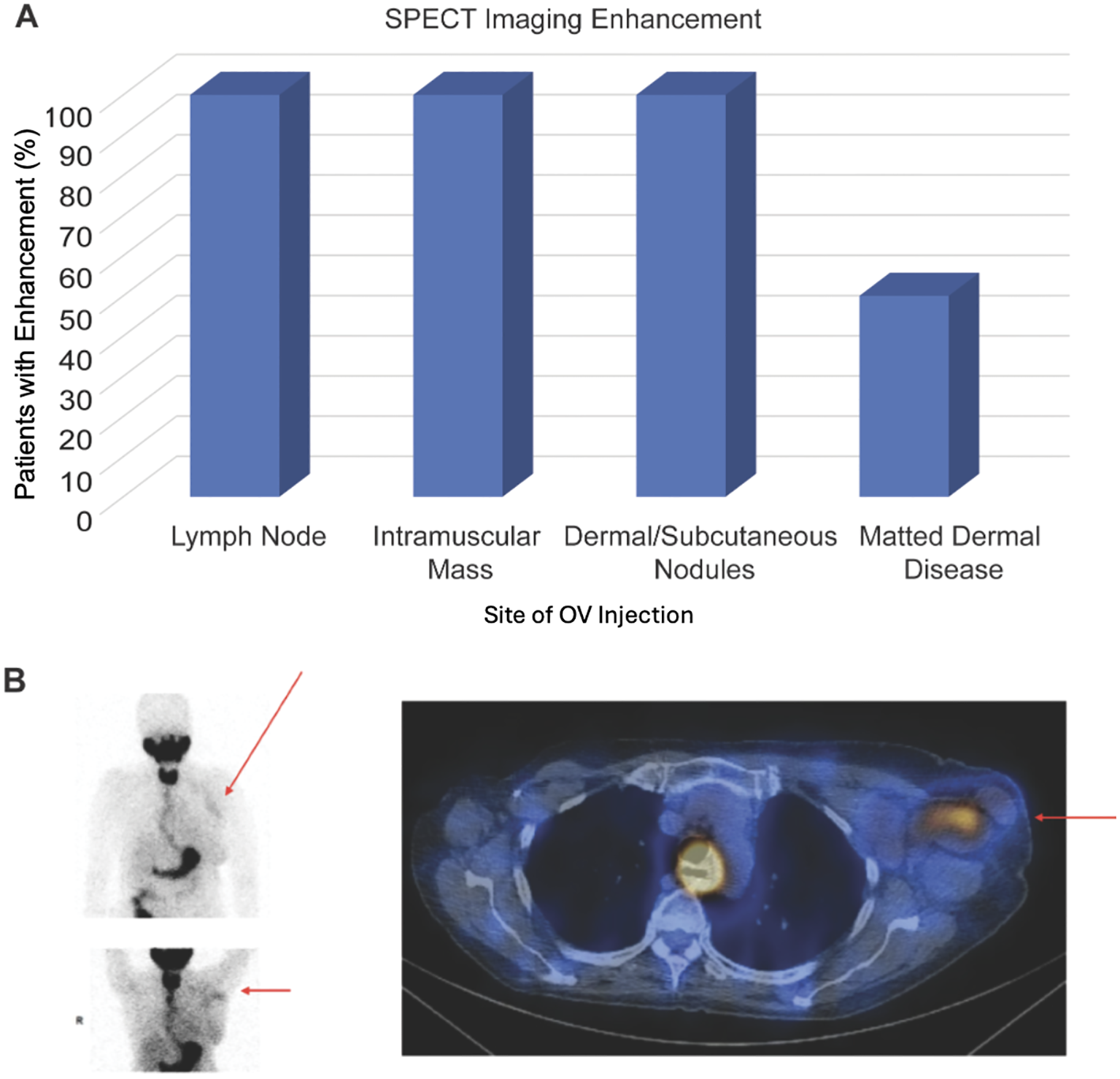 Bar chart and medical imaging related to SPECT imaging enhancement. Chart A shows high enhancement percentages for lymph nodes, intramuscular mass, and dermal/subcutaneous nodules, with lower for matted dermal disease. Images B include labeled scans indicating specific areas of interest with red arrows.